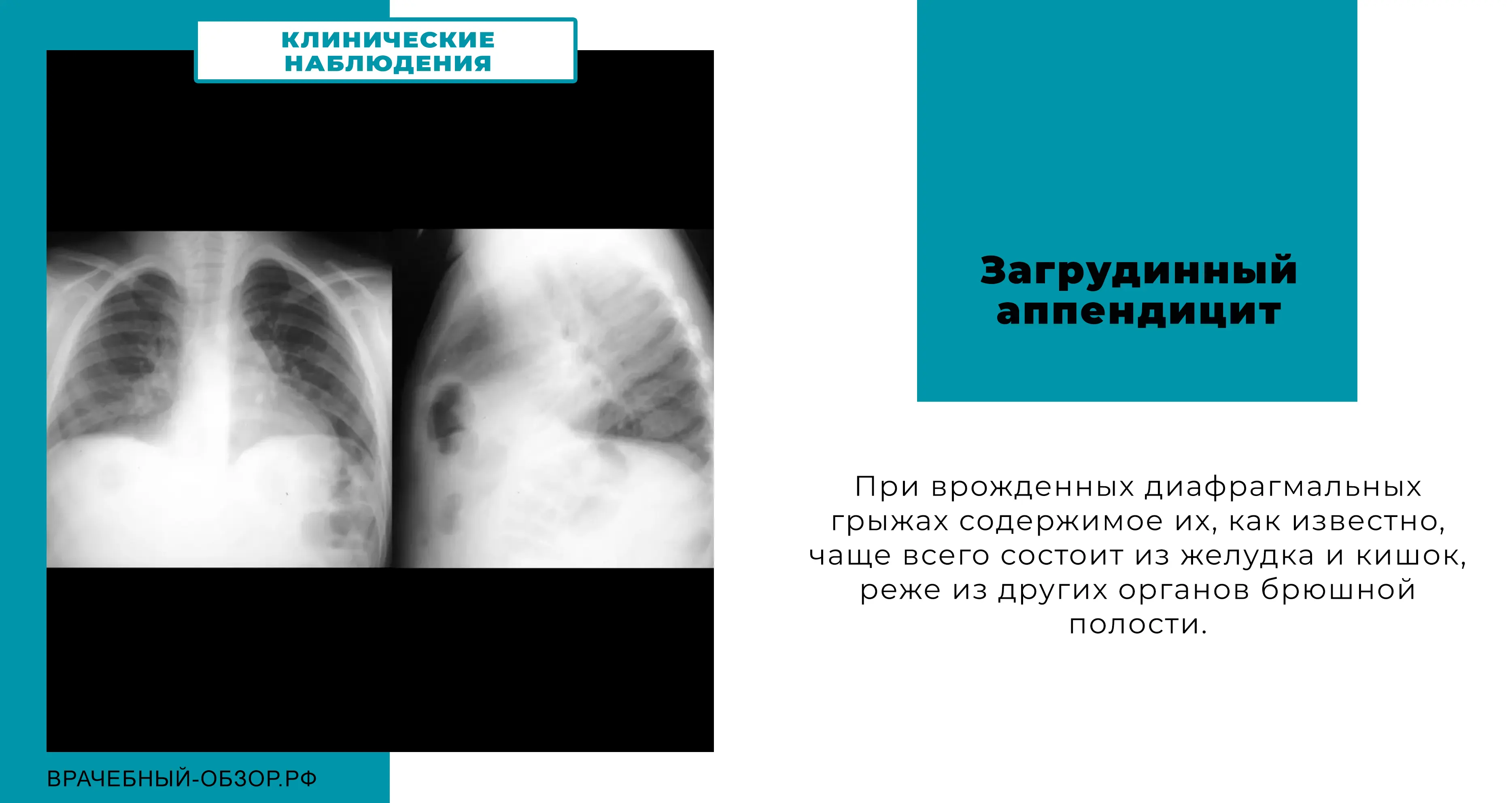 Загрудинный аппендицит