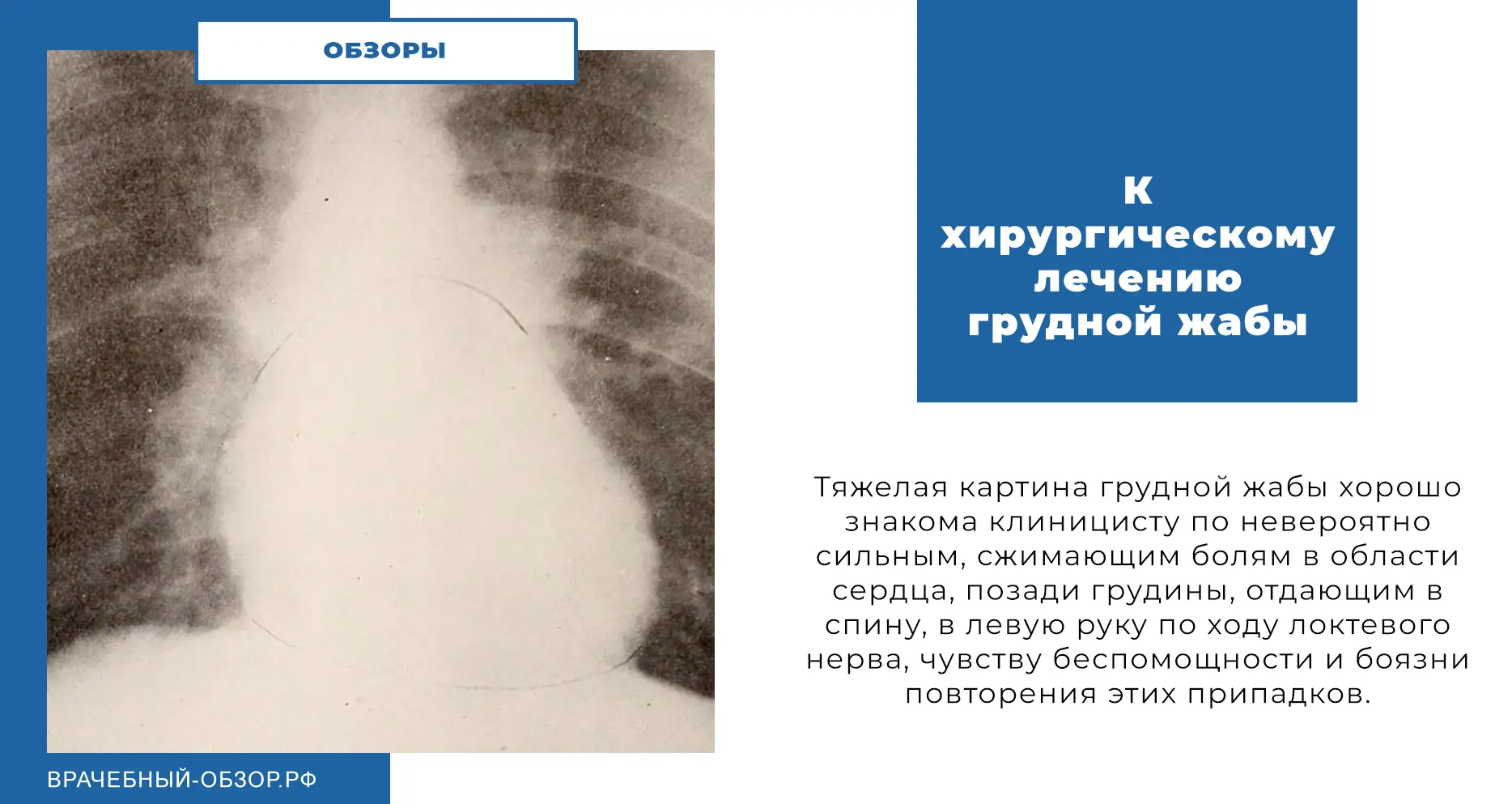 К хирургическому лечению грудной жабы