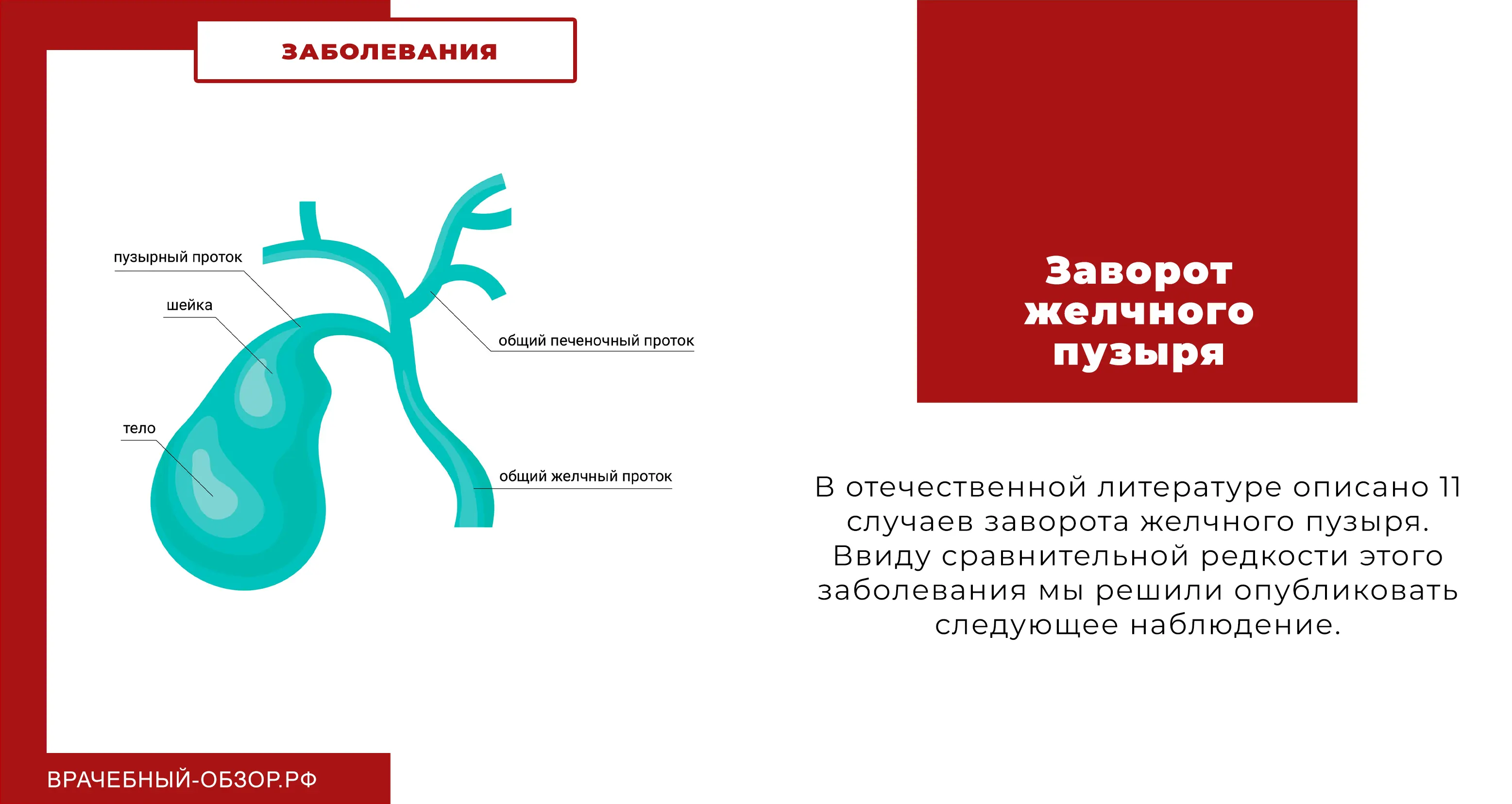 Заворот желчного пузыря