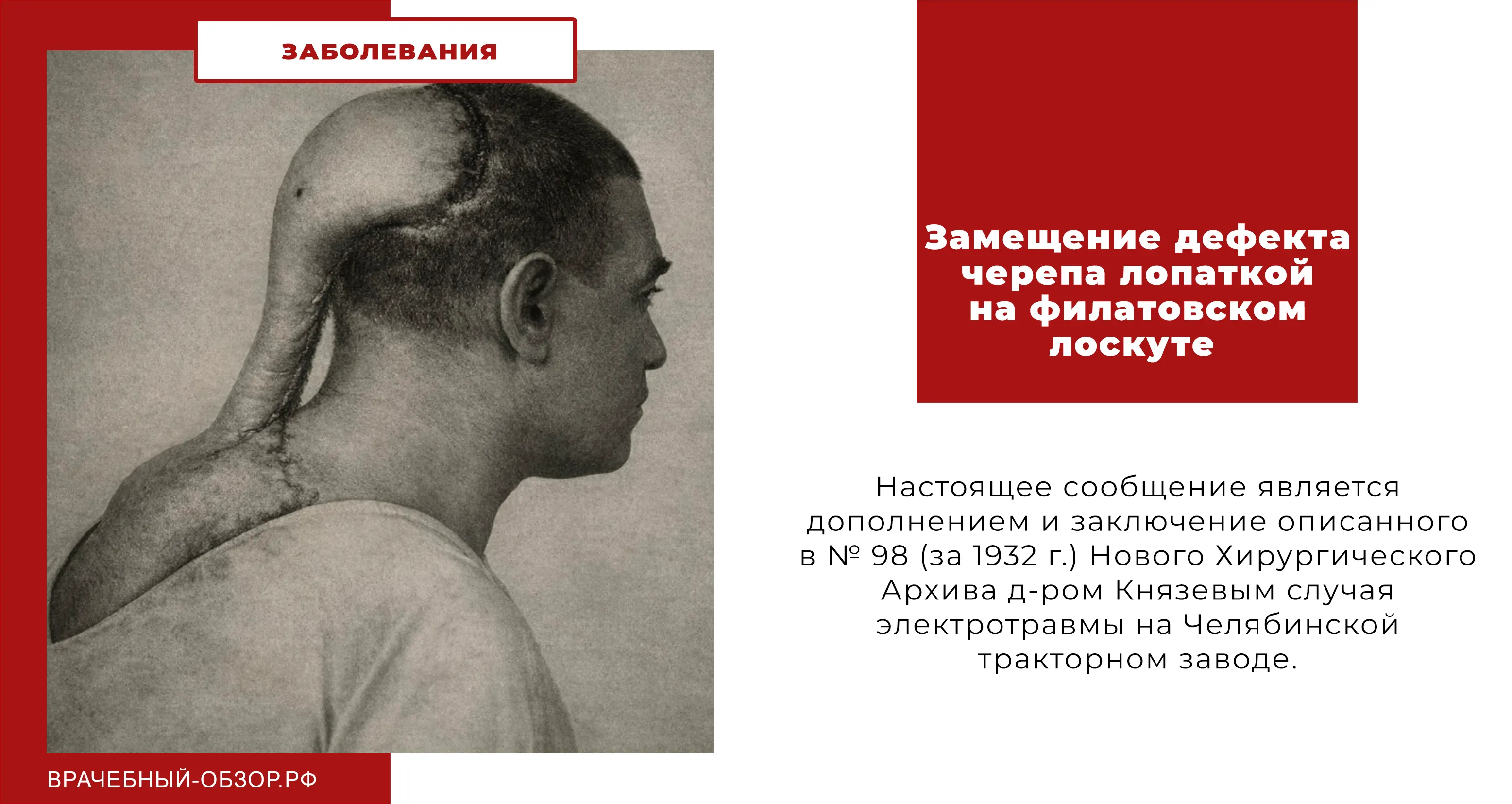 Замещение дефекта черепа лопаткой на филатовском лоскуте