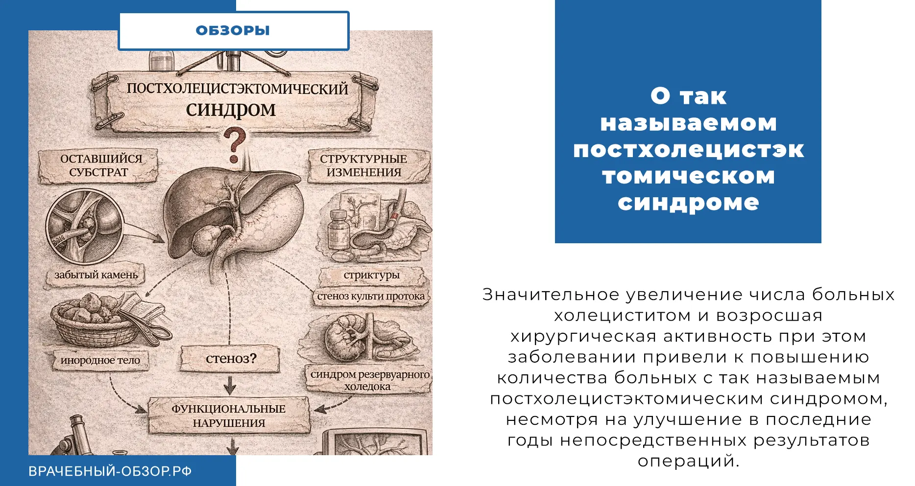 О так называемом постхолецистэктомическом синдроме