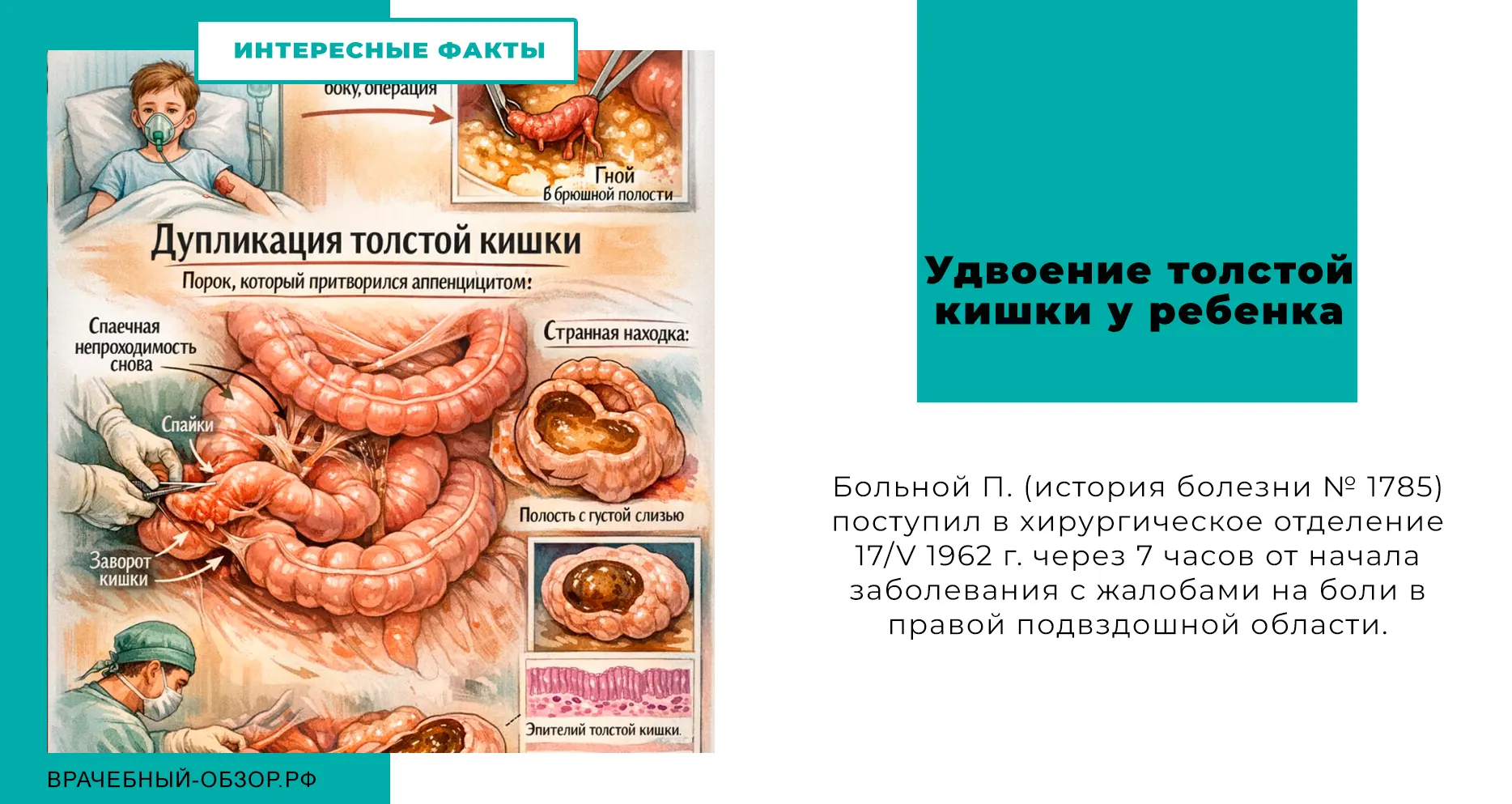 Удвоение толстой кишки у ребенка