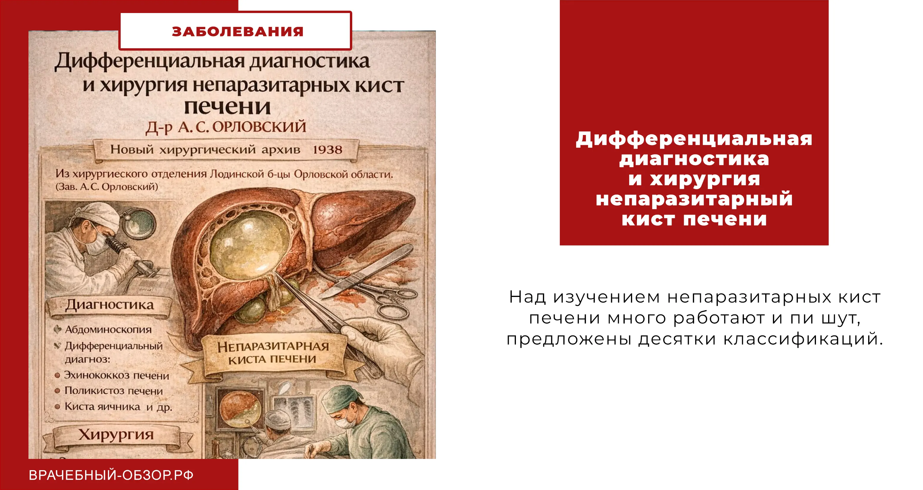 Дифференциальная диагностика и хирургия непаразитарный кист печени