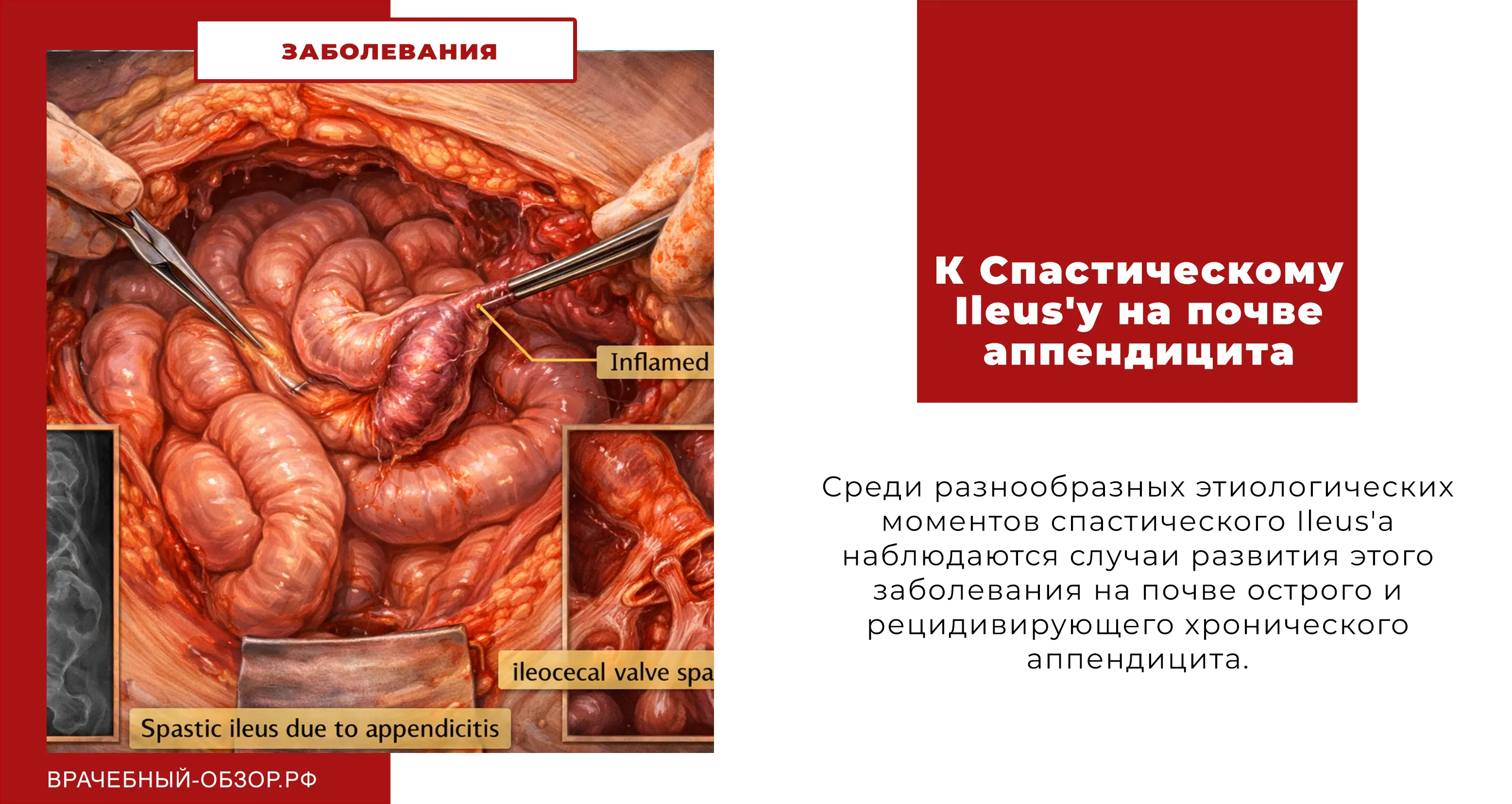 К Спастическому Ileus'y на почве аппендицита.