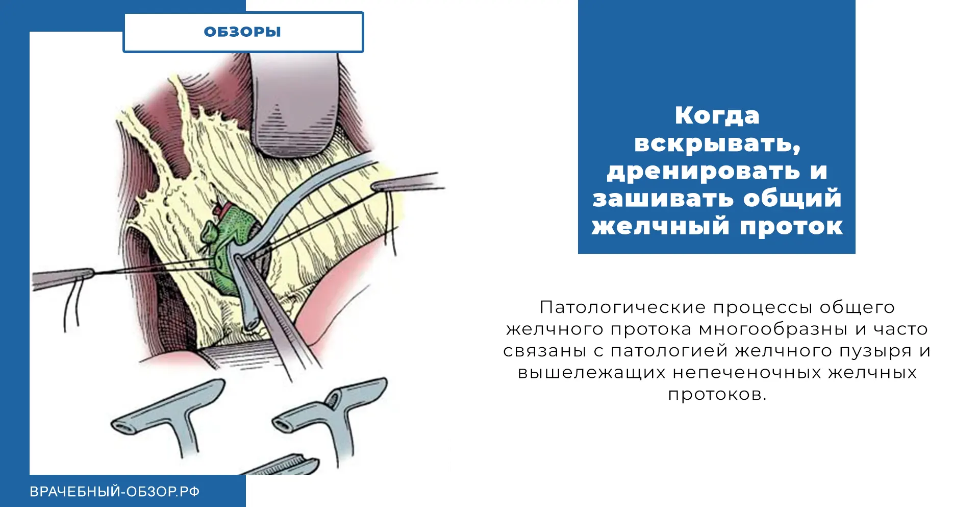 Когда вскрывать, дренировать и зашивать общий желчный проток