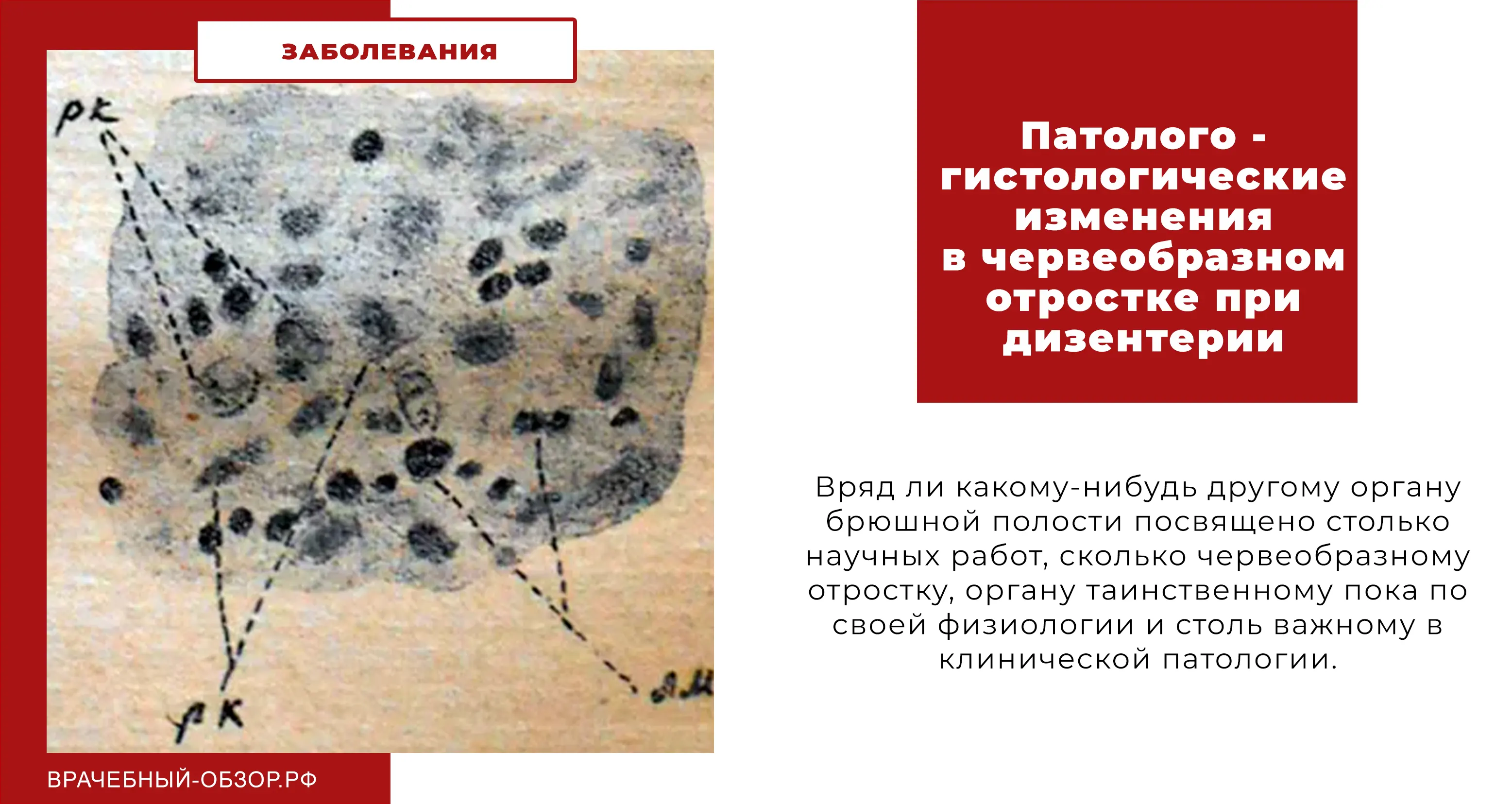 Патолого - гистологические изменения в червеобразном отростке при дизентерии