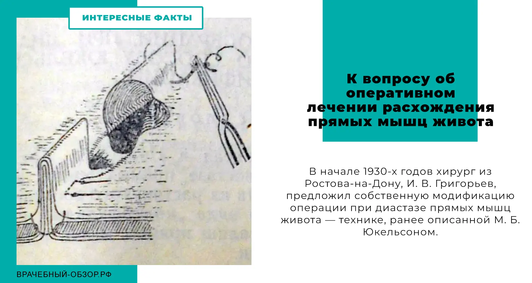 К вопросы об оперативном лечении расхождения прямых мышц живота