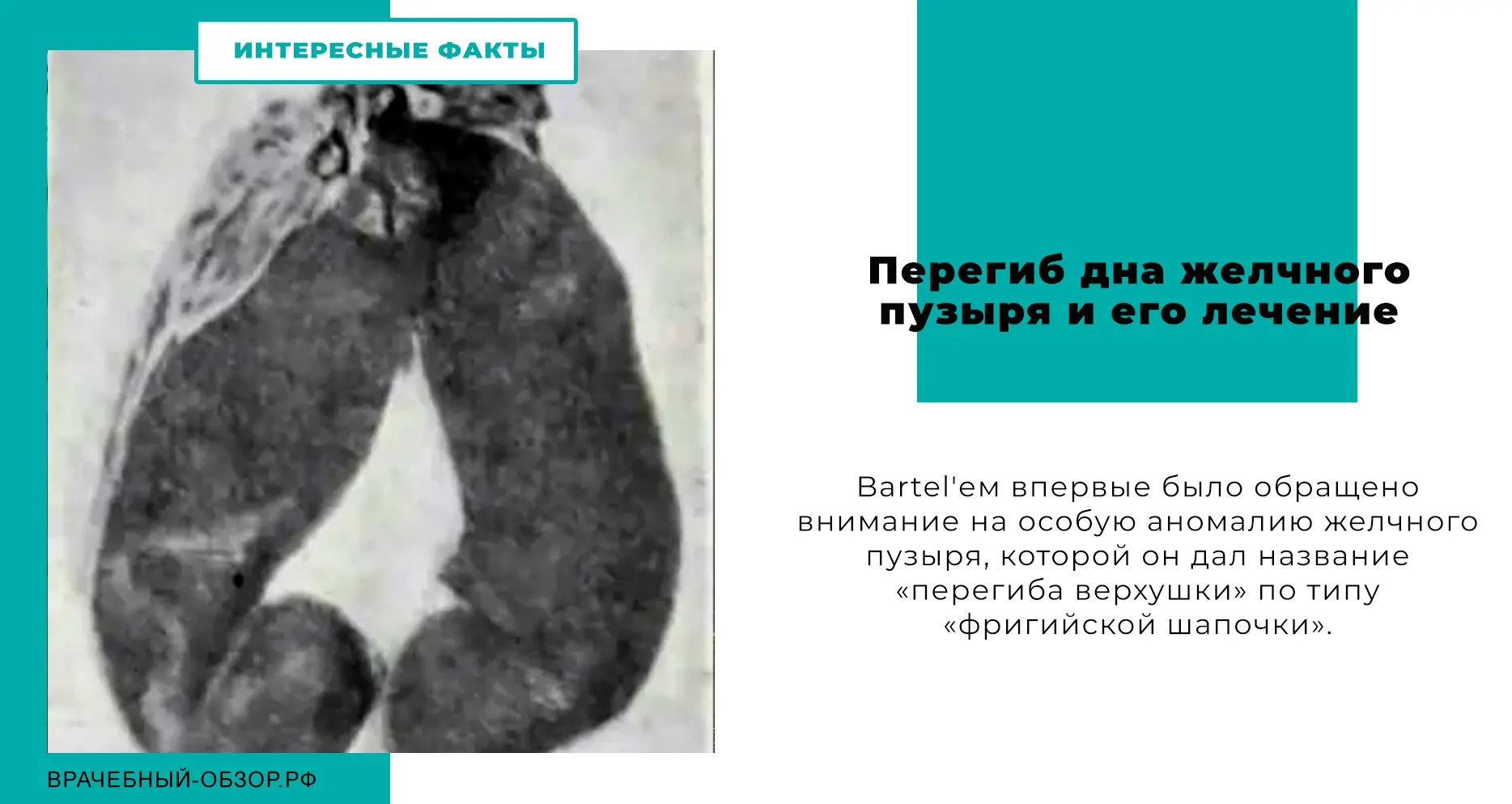 Перегиб дна желчного пузыря и его лечение