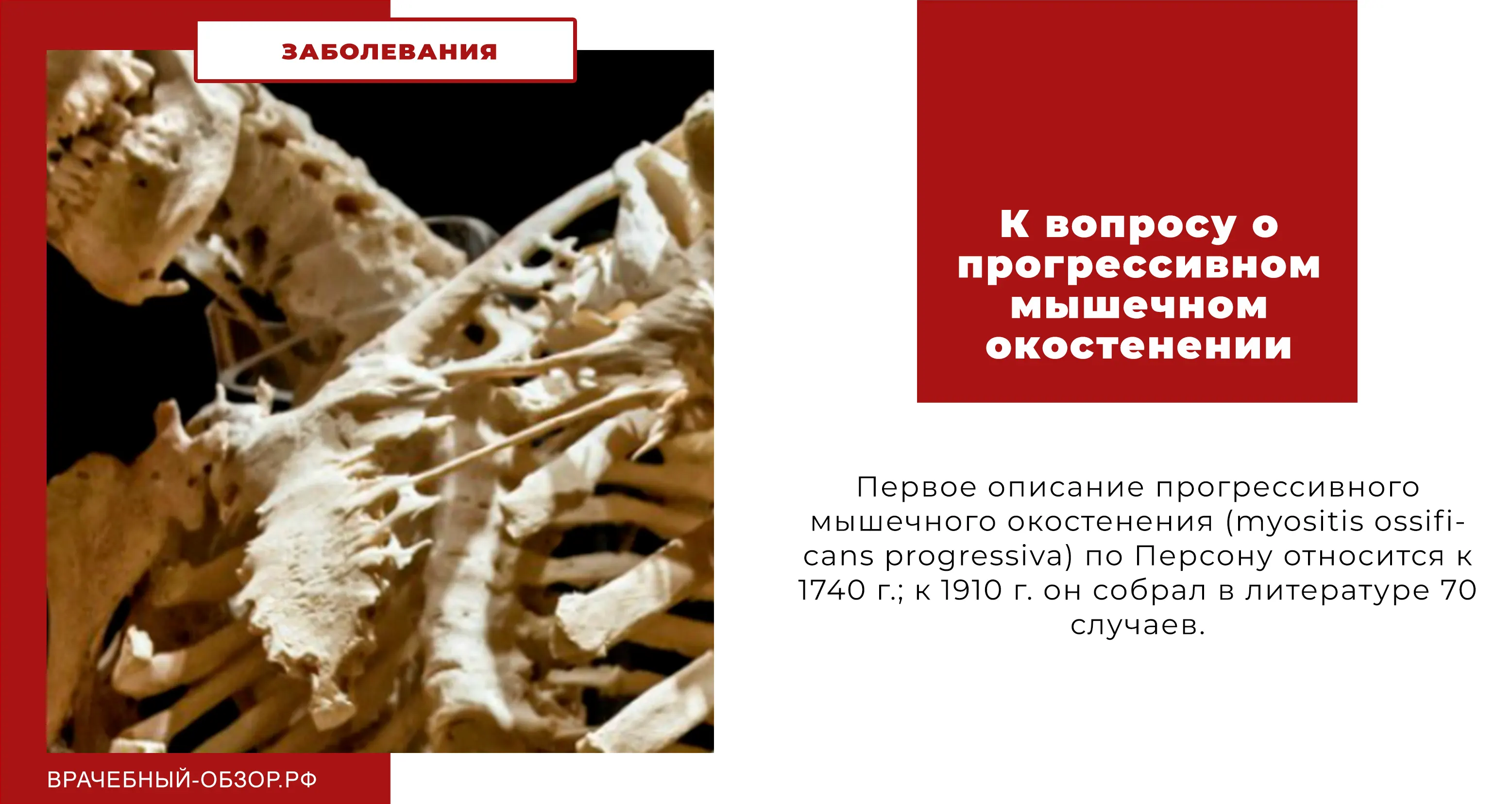 К вопросу о прогрессивном мышечном окостенении
