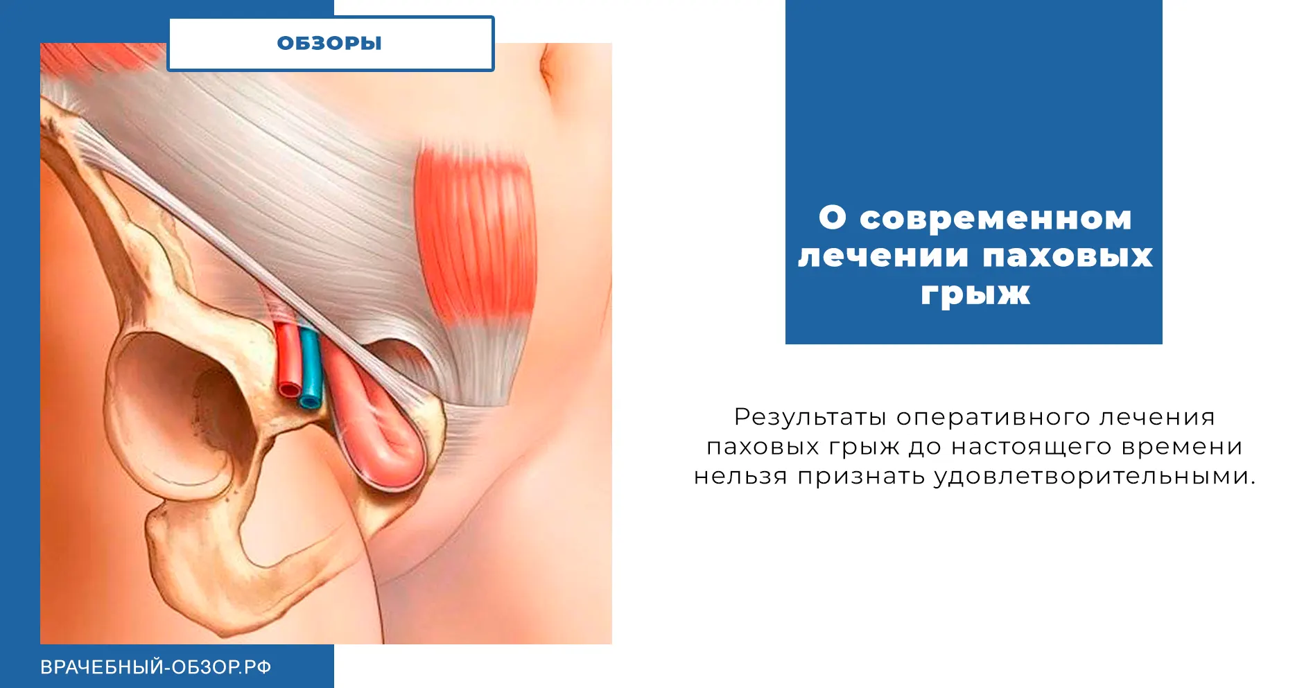 О современном лечении паховых грыж