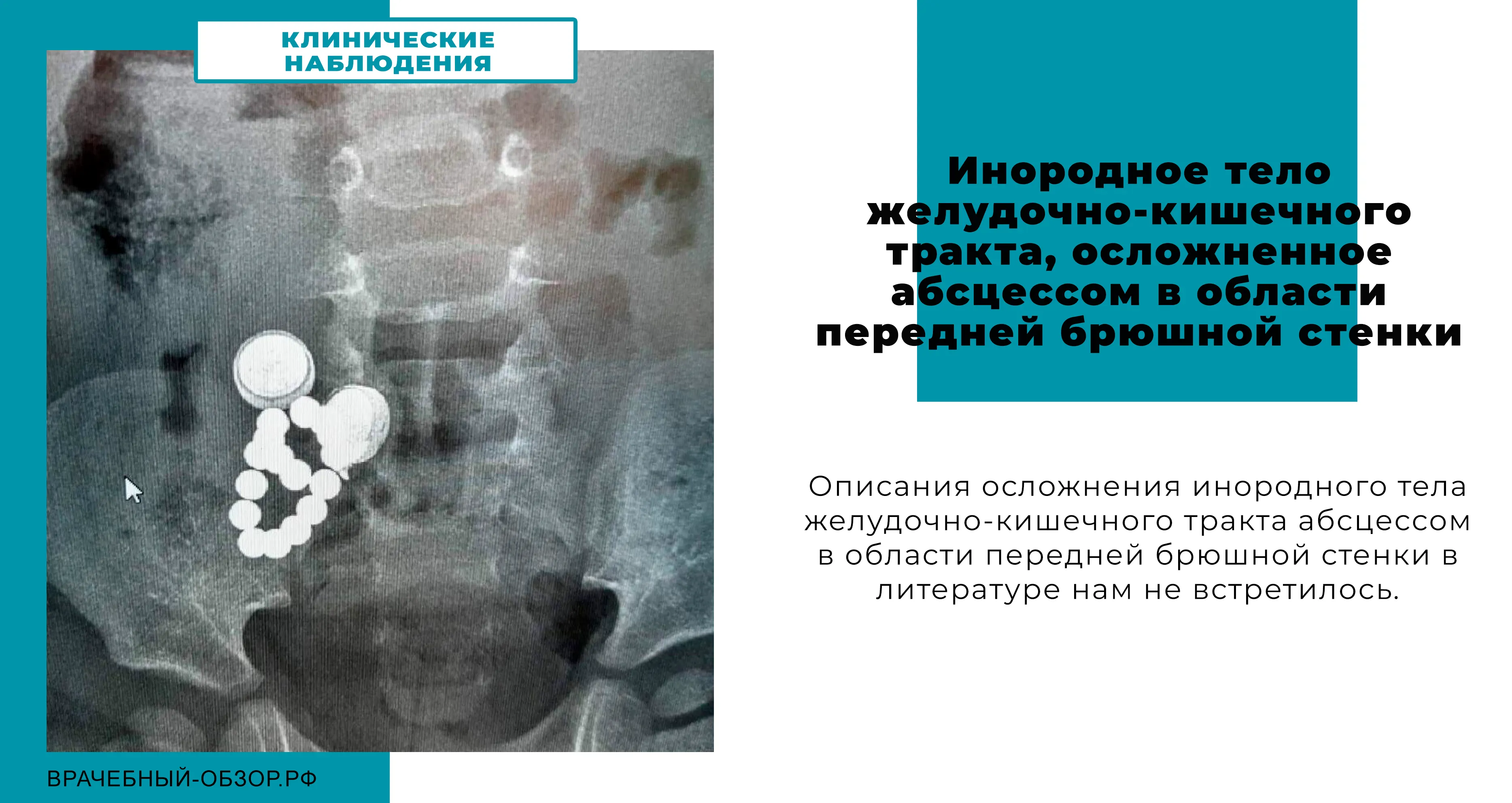 Инородное тело желудочно-кишечного тракта, осложненное абсцессом в области передней брюшной стенки
