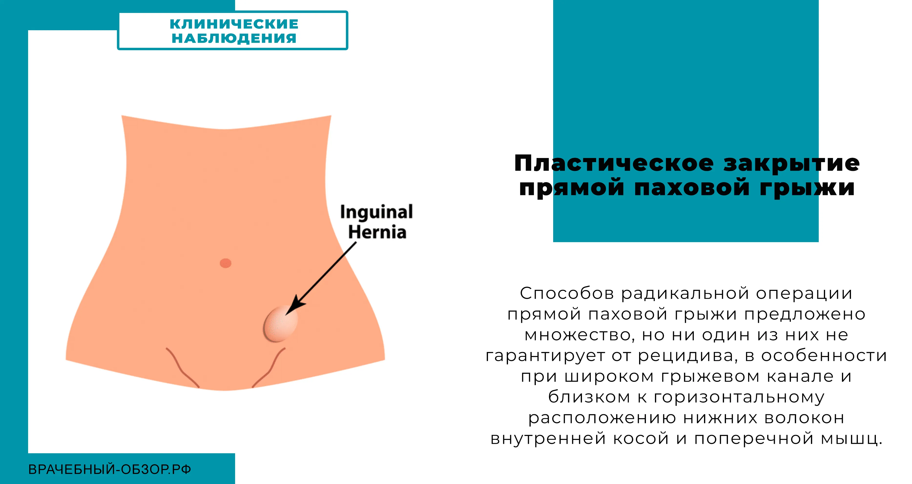 Пластическое закрытие прямой паховой грыжи