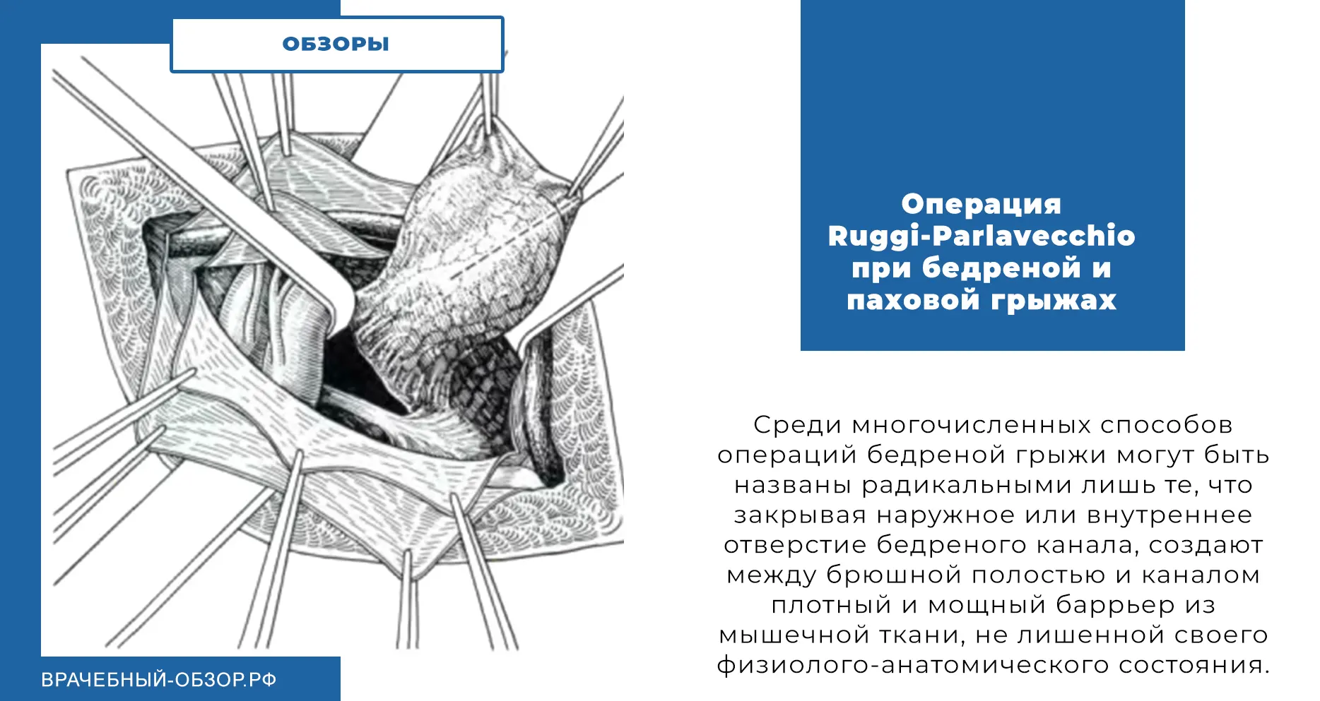 Операция Ruggi-Parlavecchio при бедреной и паховой грыжах