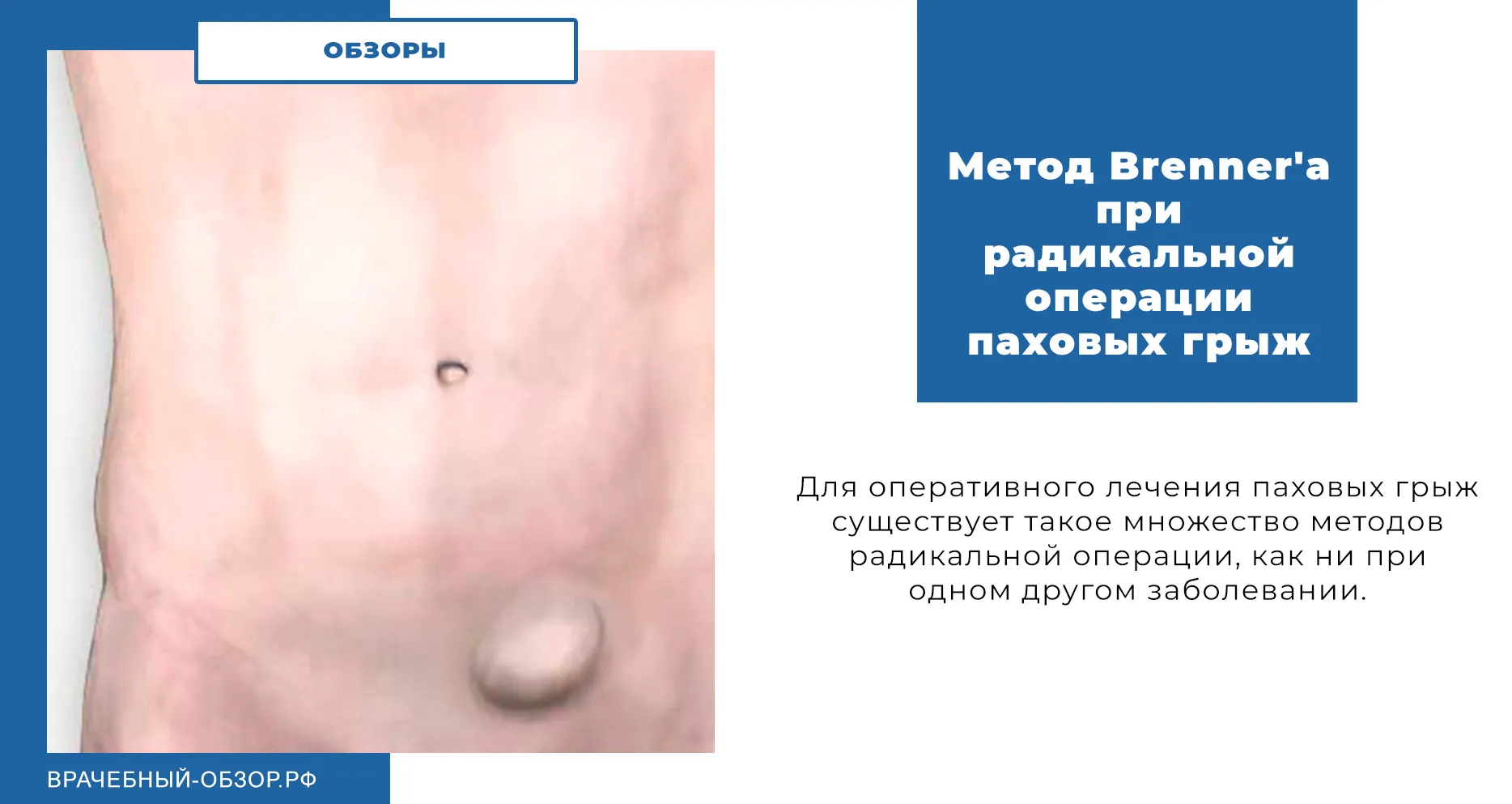 Метод Brenner'a при радикальной операции паховых грыж