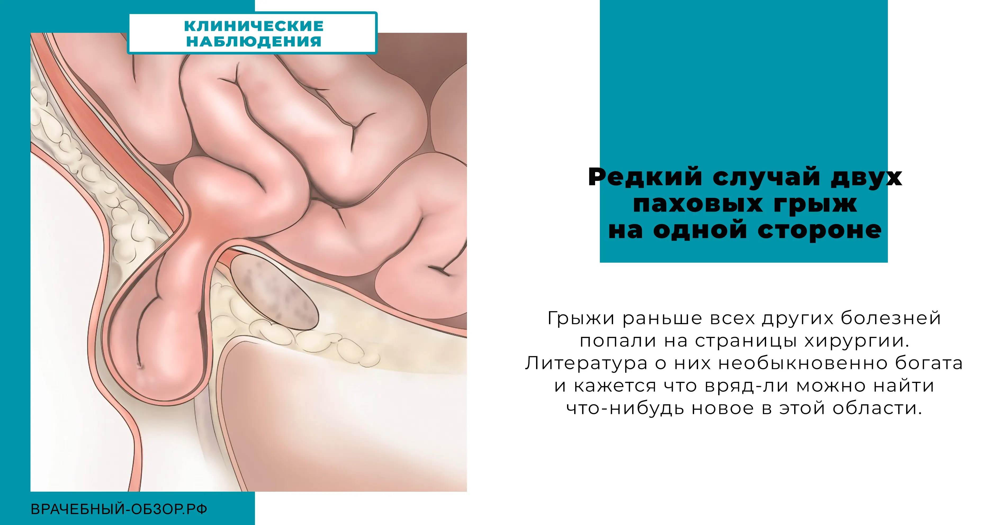 Редкий случай двух паховых грыж на одной стороне.
