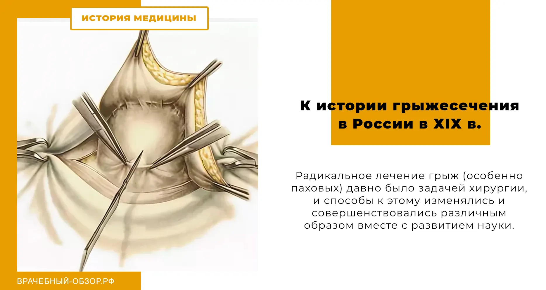 К истории грыжесечения в России в ХІХ в.