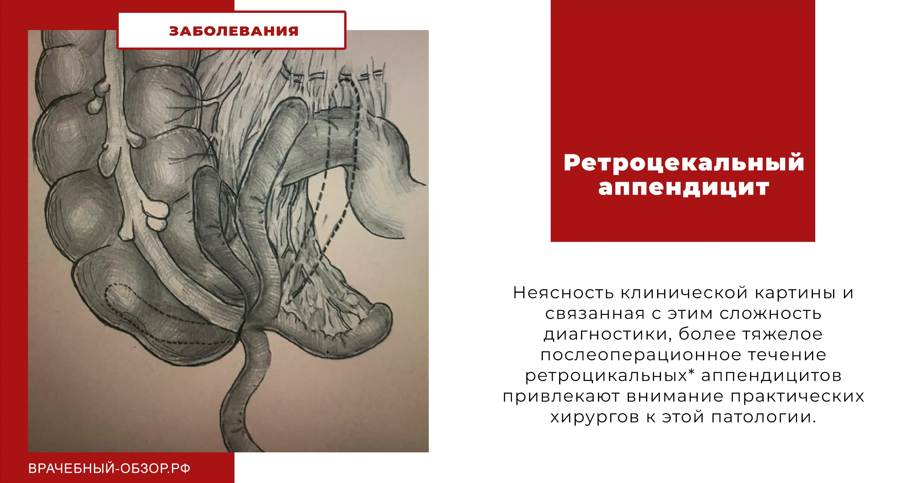 Ретроцекальный аппендицит
