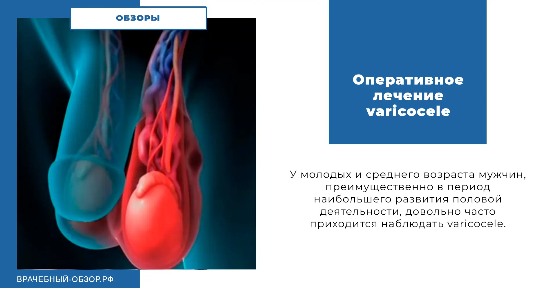 Оперативное лечение varicocele