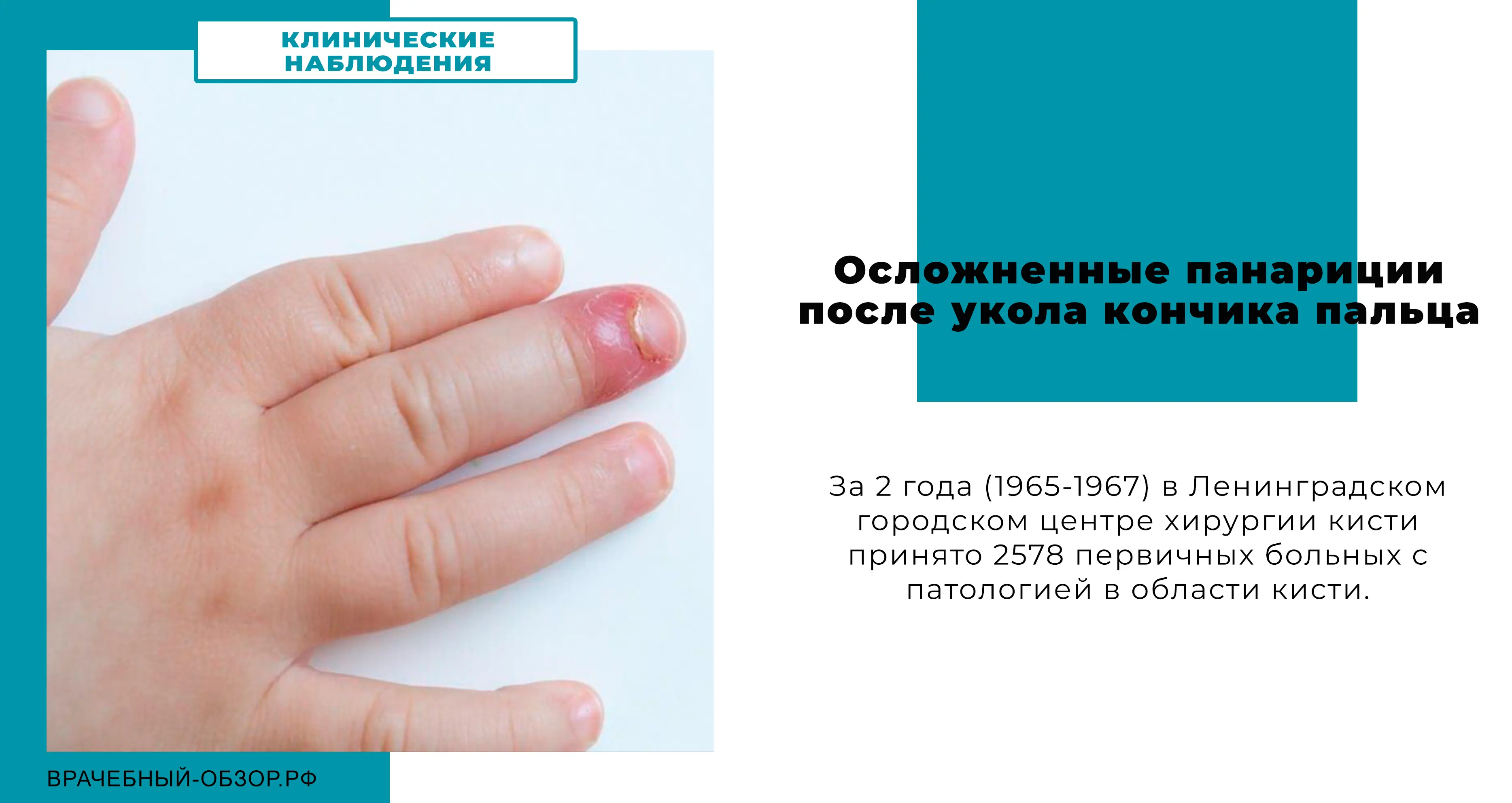 Осложненные панариции после укола кончика пальца