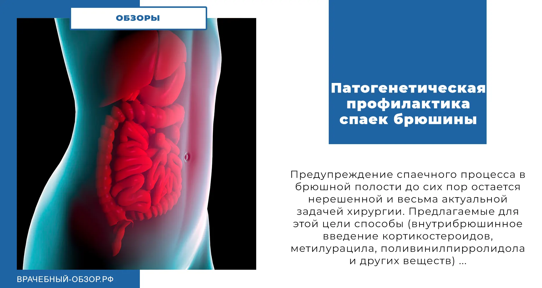 Патогенетическая профилактика спаек брюшины