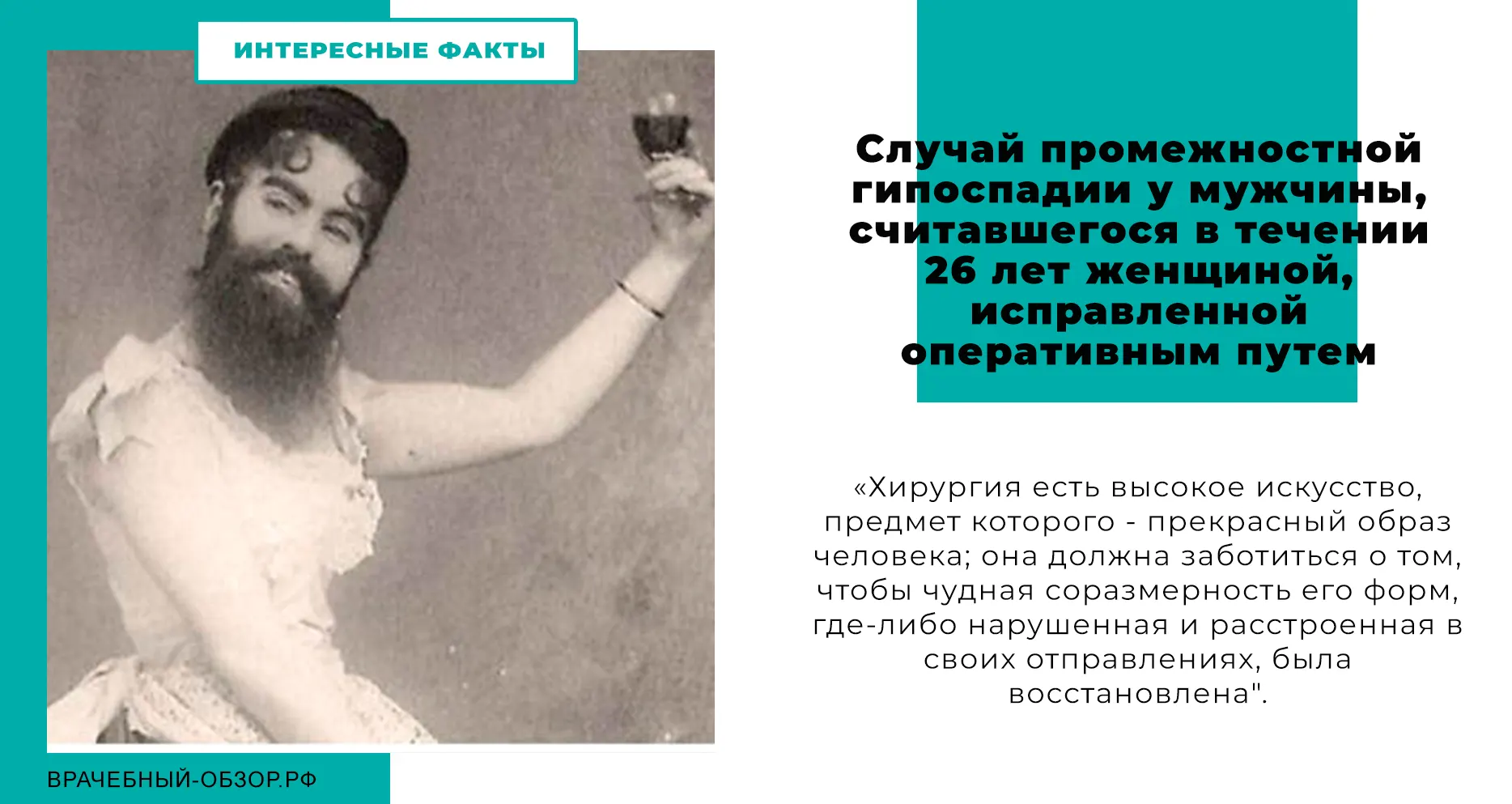 Случай промежностной гипоспадии у мужчины, считавшегося в течении 26 лет женщиной, исправленной оперативным путем.