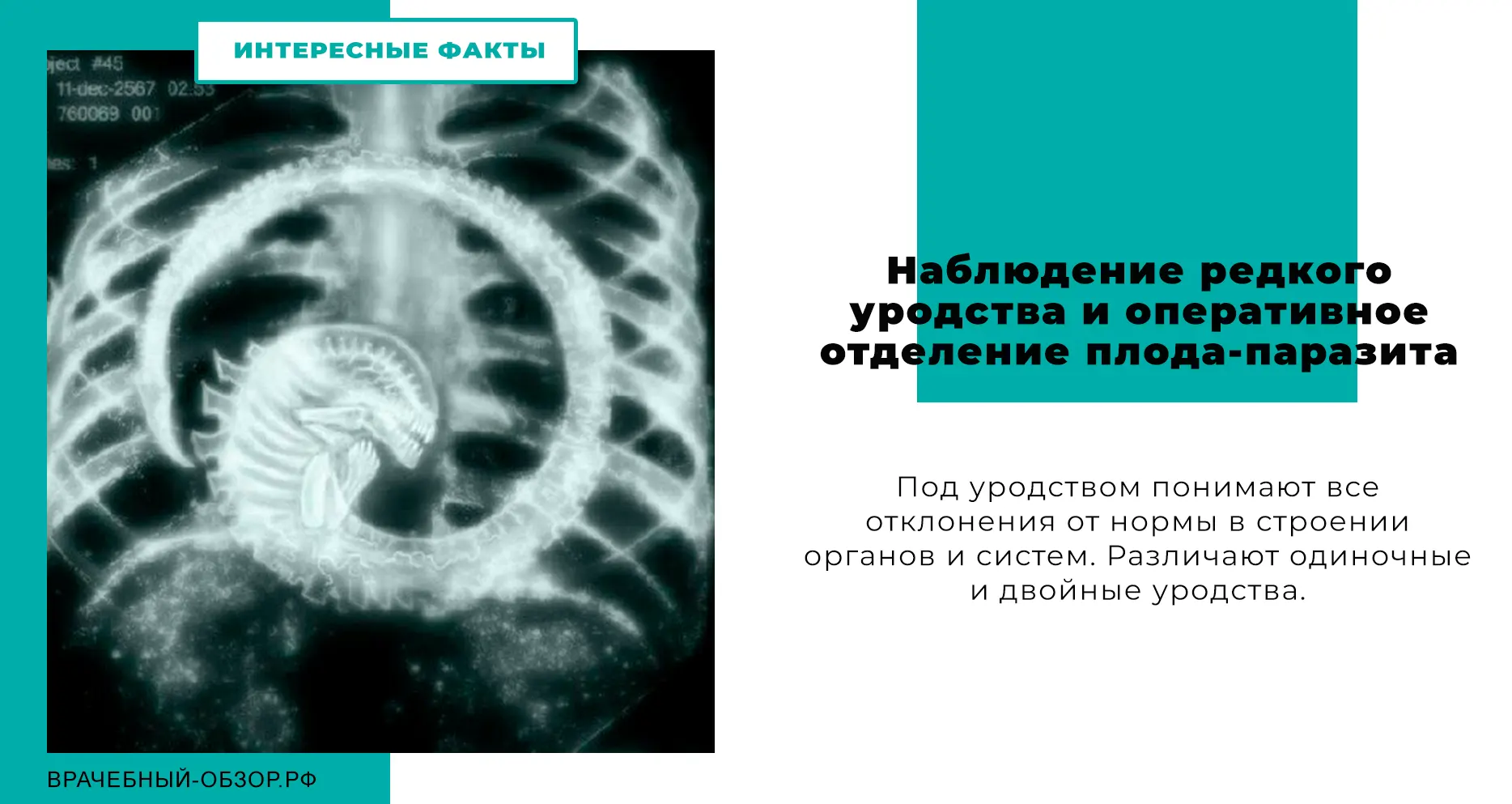 Наблюдение редкого уродства и оперативное отделение плода-паразита