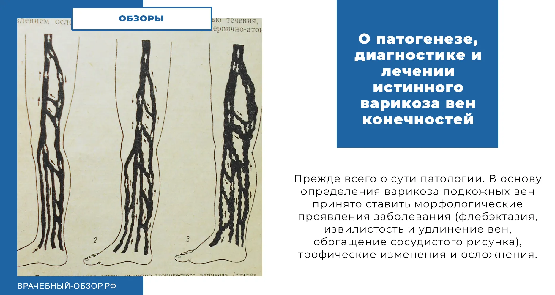О патогенезе, диагностике и лечении истинного варикоза вен конечностей