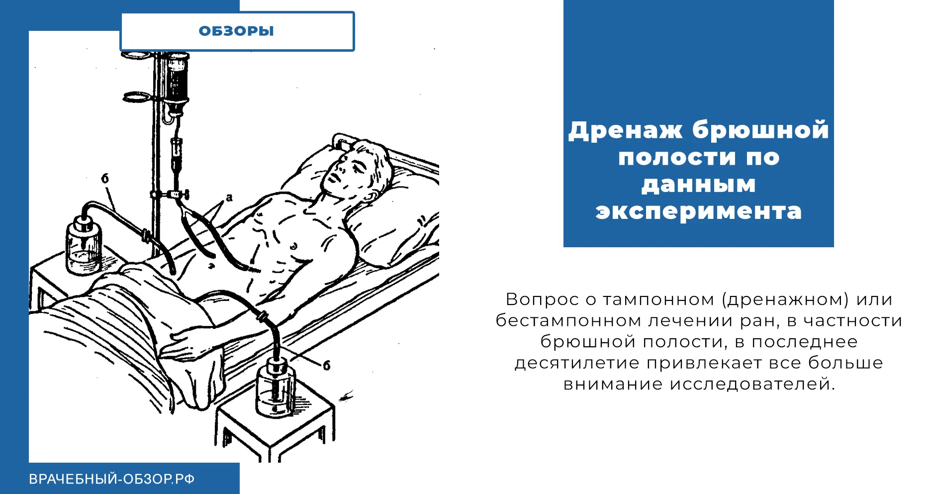 Дренаж брюшной полости по данным эксперимента