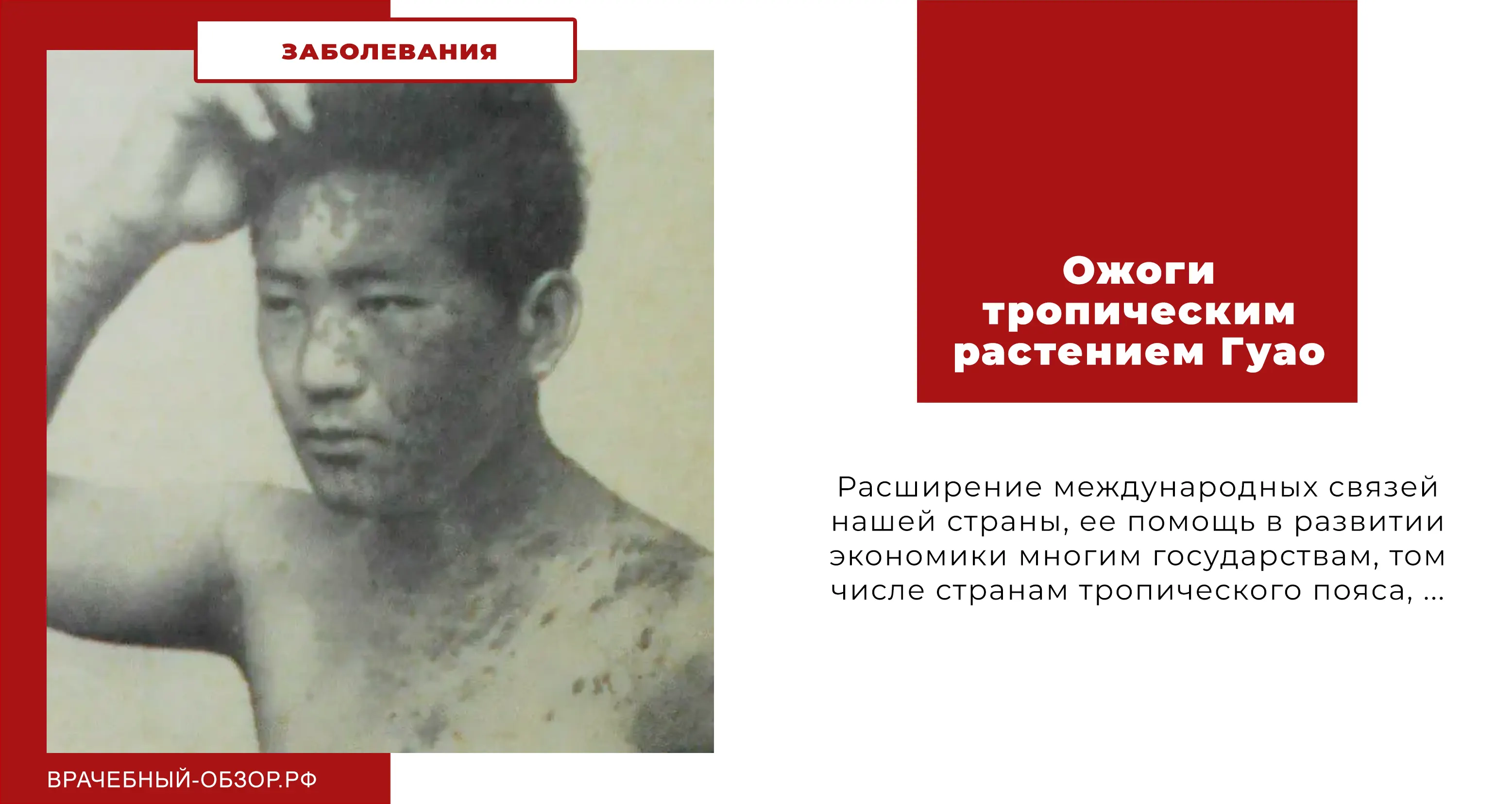 Ожоги тропическим растением Гуао