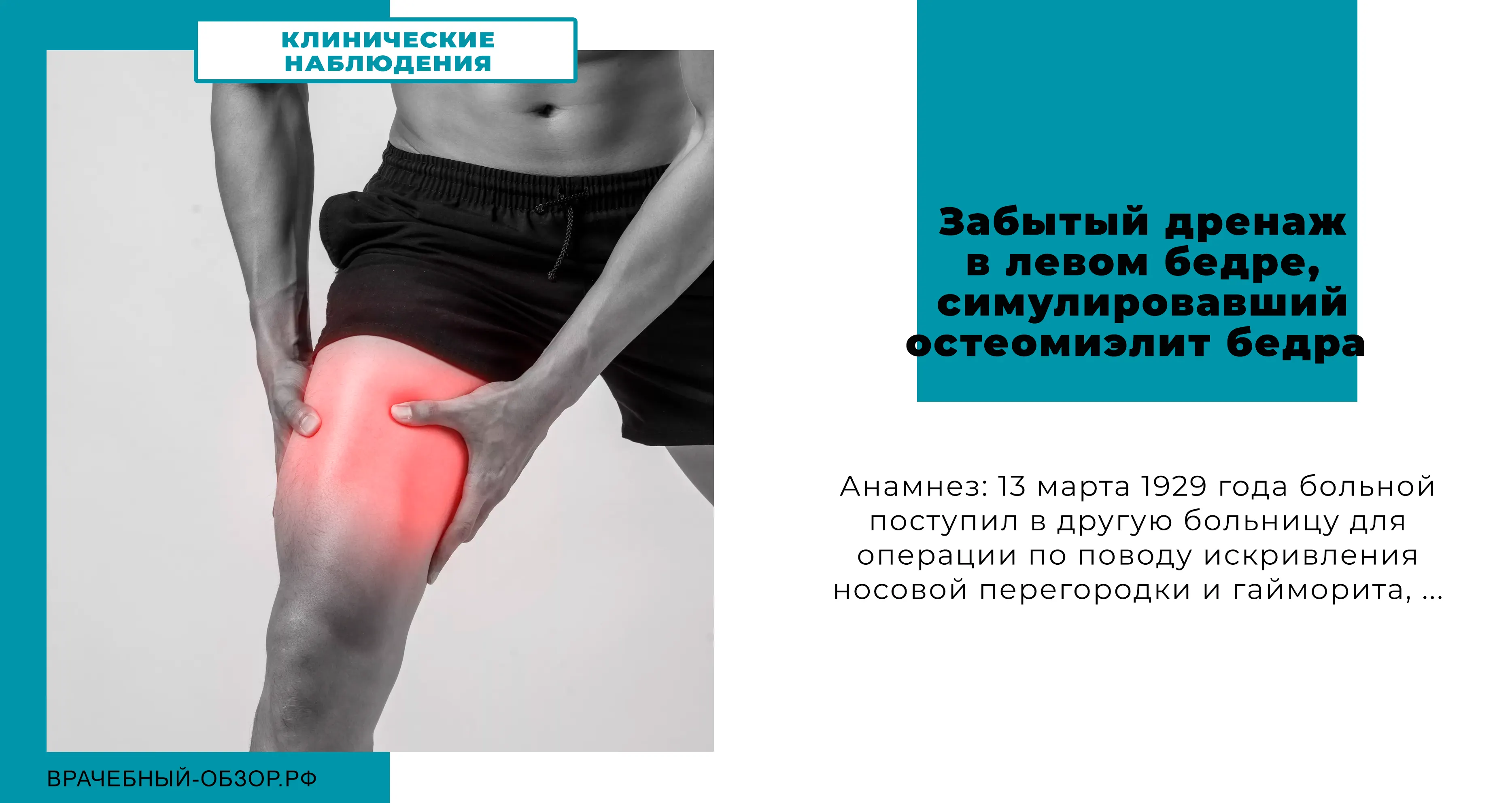 Забытый дренаж в левом бедре, симулировавший остеомиэлит бедра