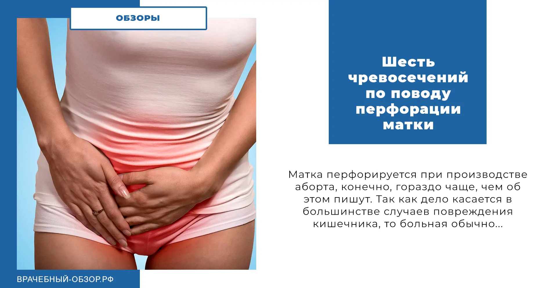 Шесть чревосечений по поводу перфорации матки