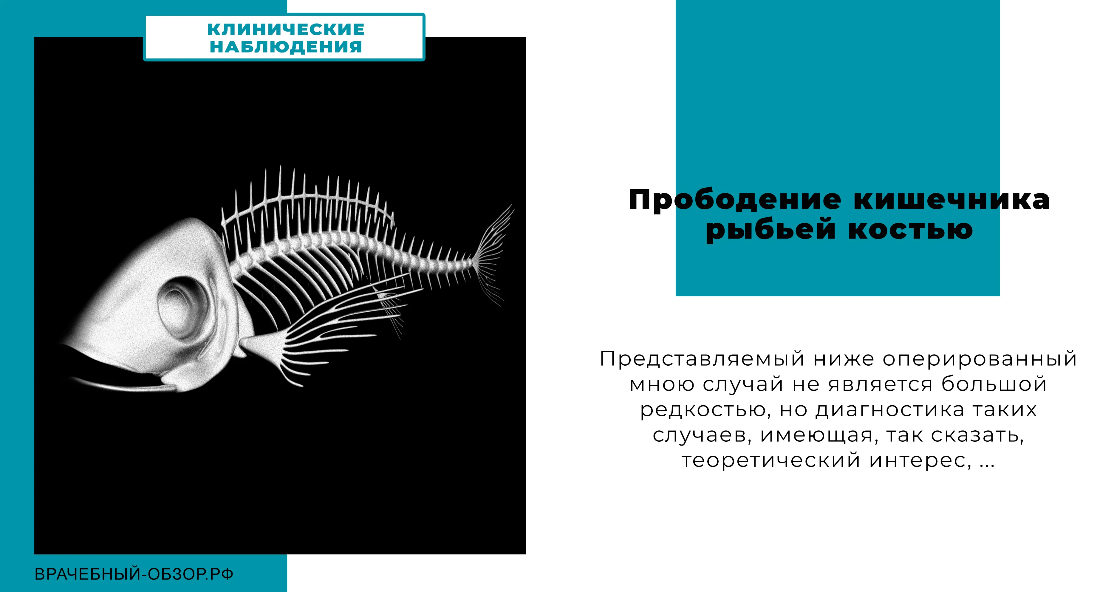 Прободение кишечника рыбьей костью