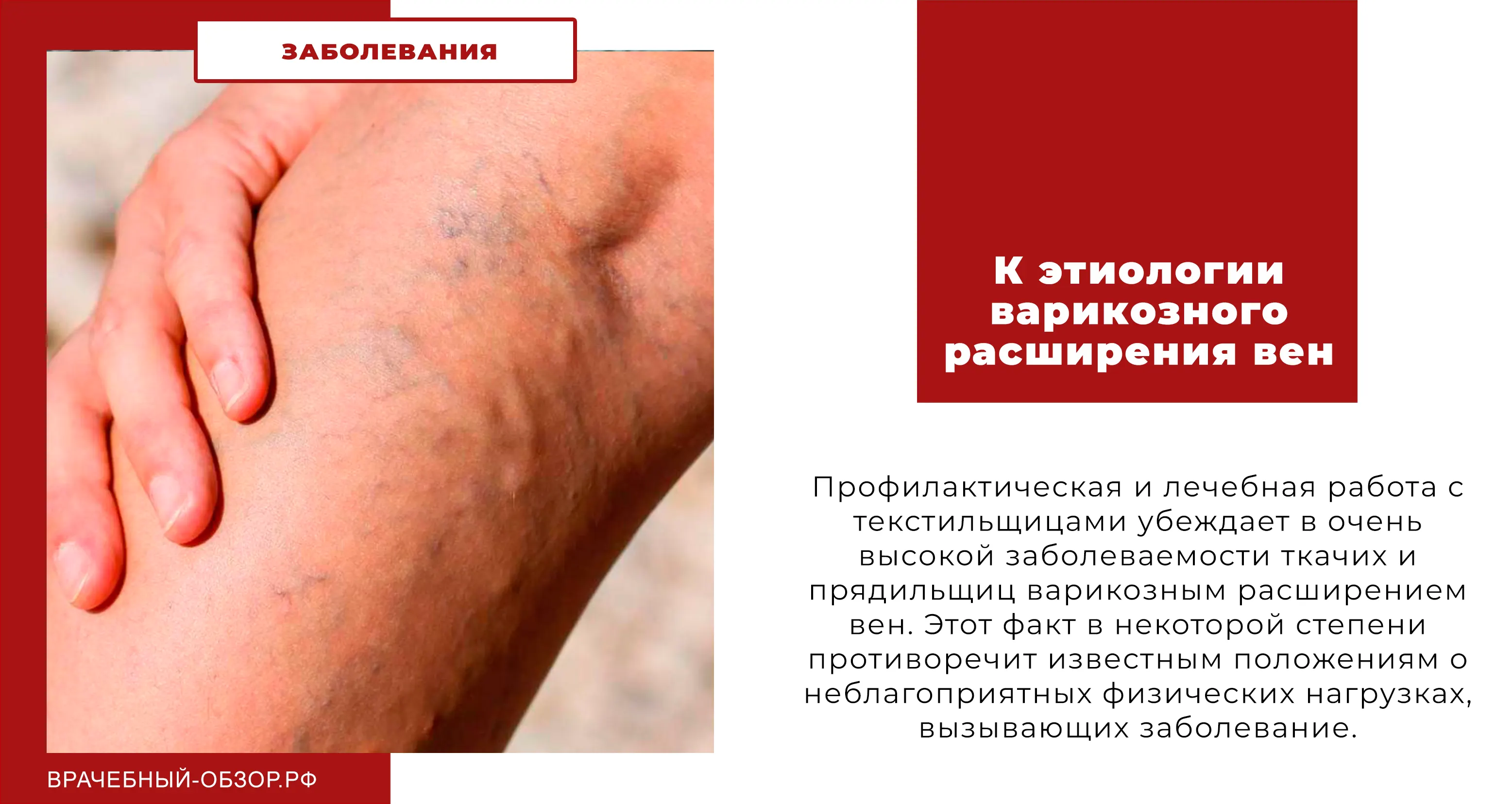 К этиологии варикозного расширения вен