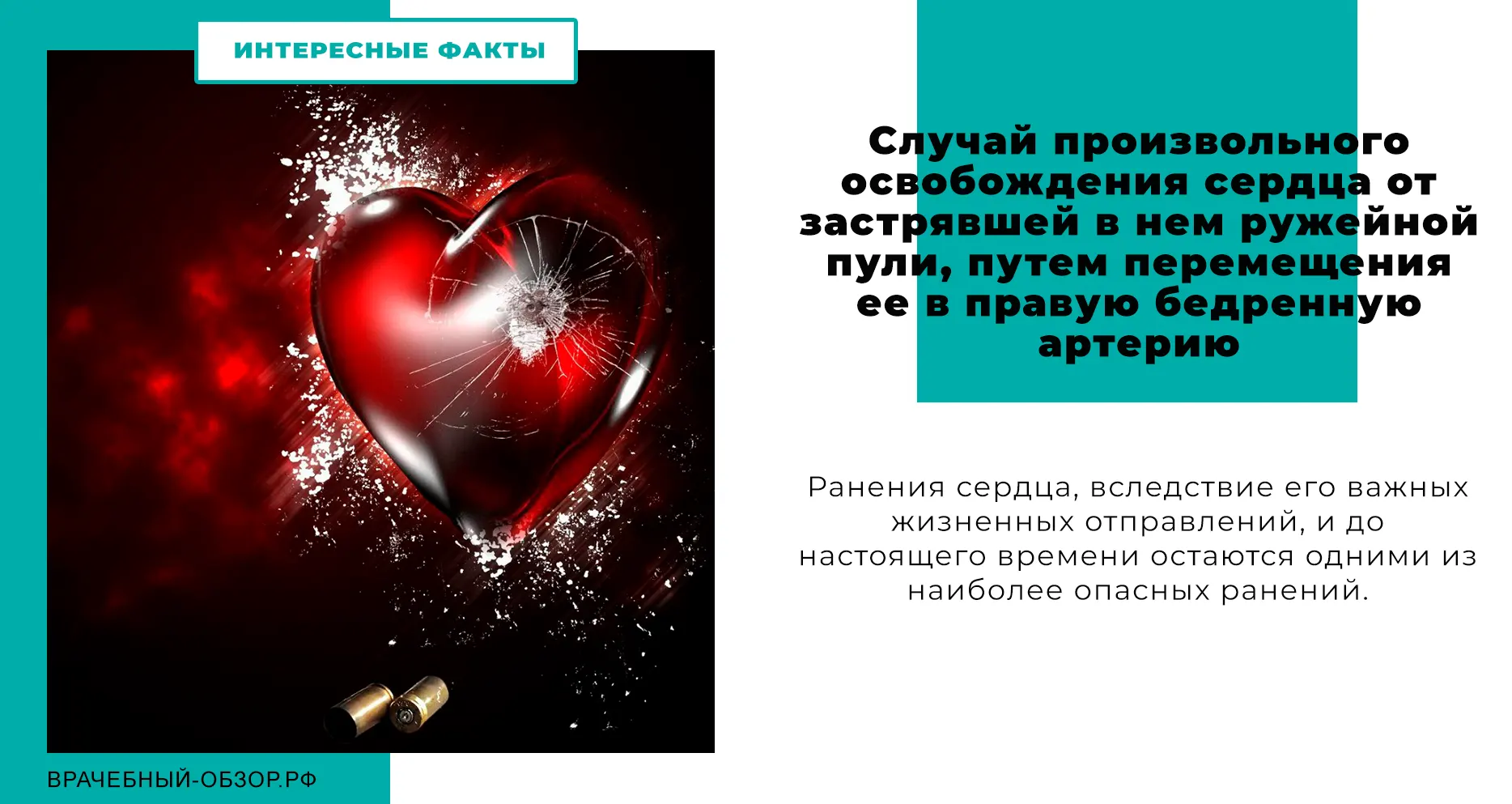 Случай произвольного освобождения сердца от застрявшей в нем ружейной пули, путем перемещения ее в правую бедренную артерию