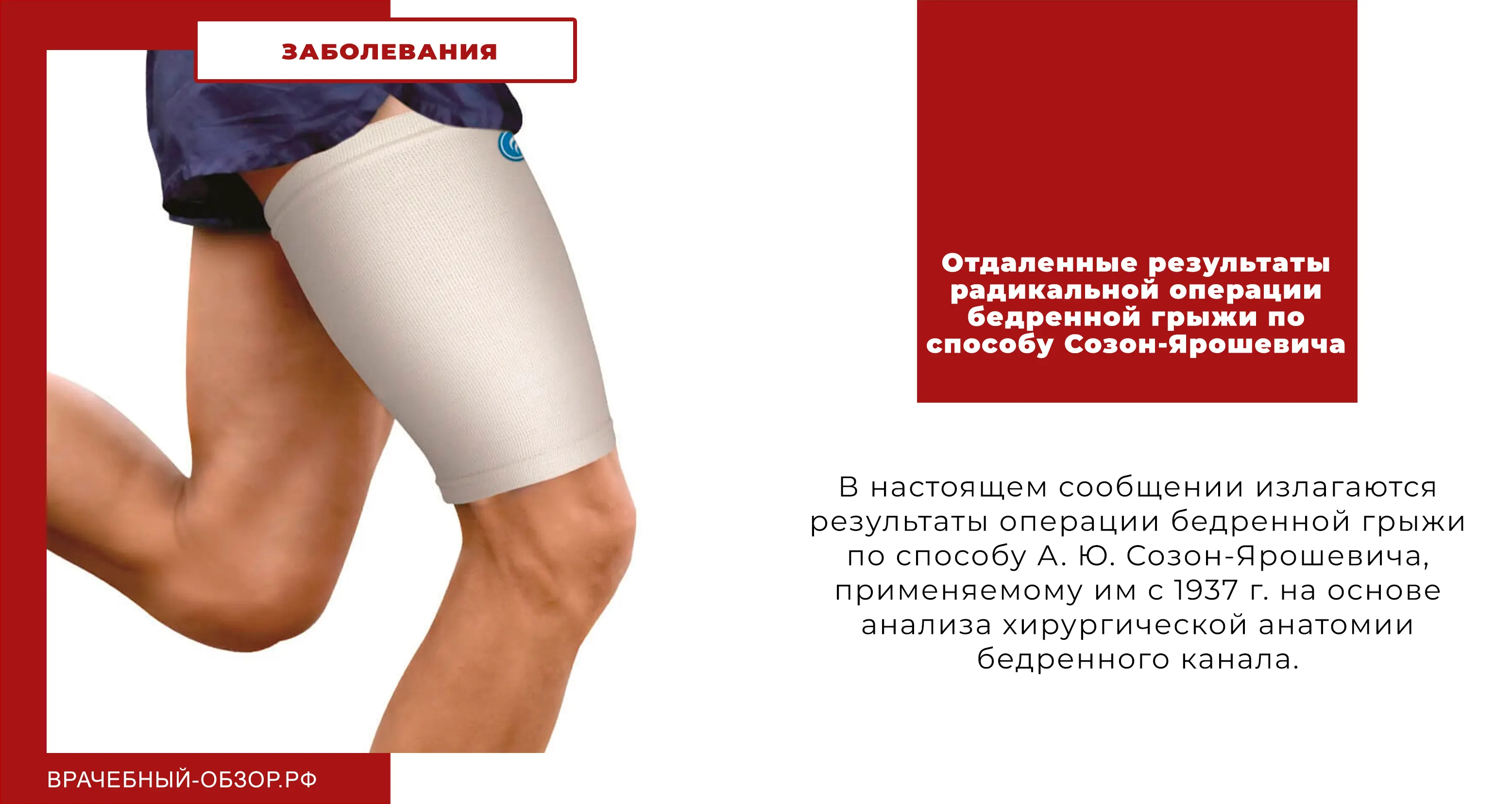 Отдаленные результаты радикальной операции бедренной грыжи по способу Созон-Ярошевича