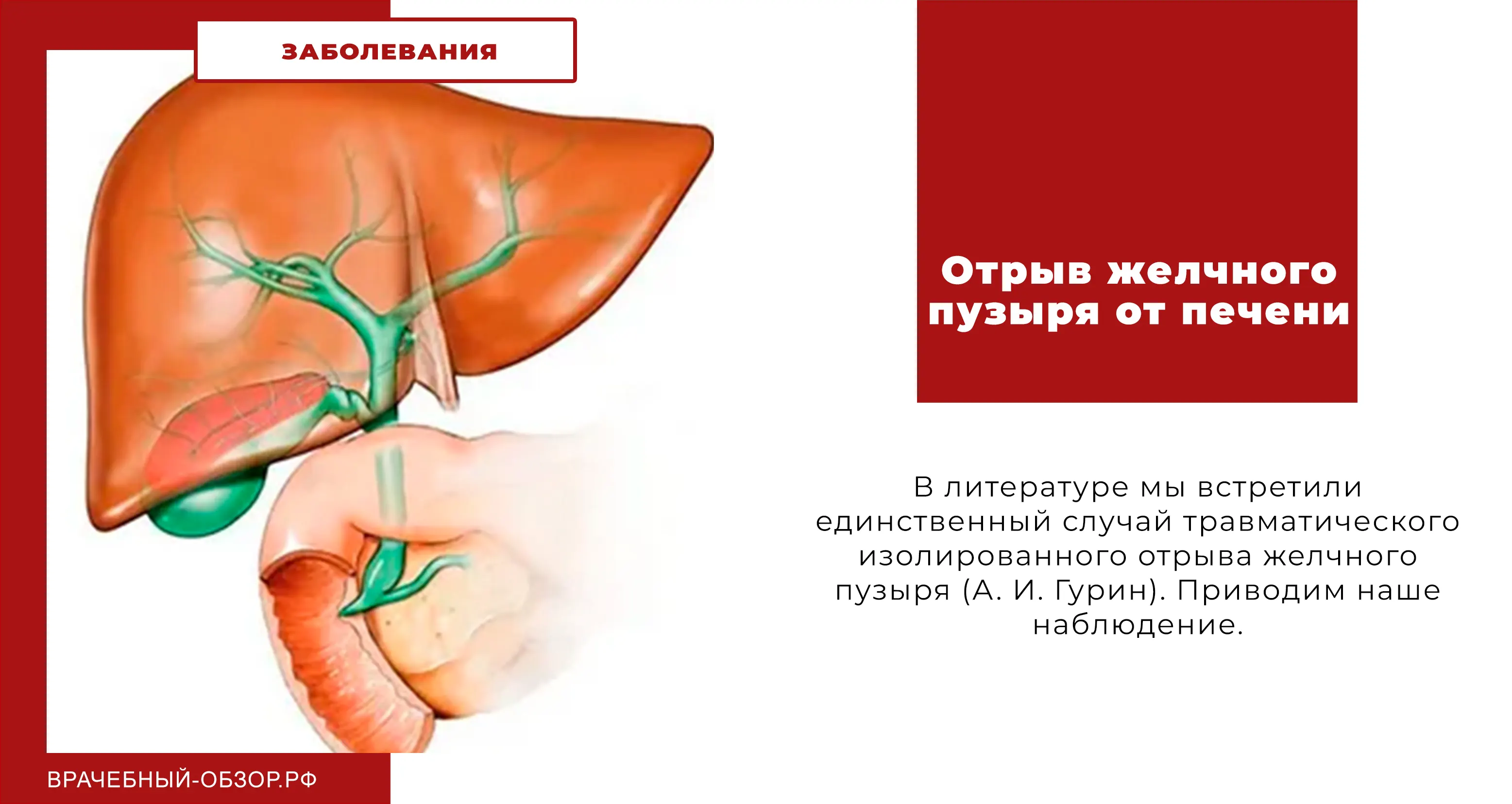 Отрыв желчного пузыря от печени