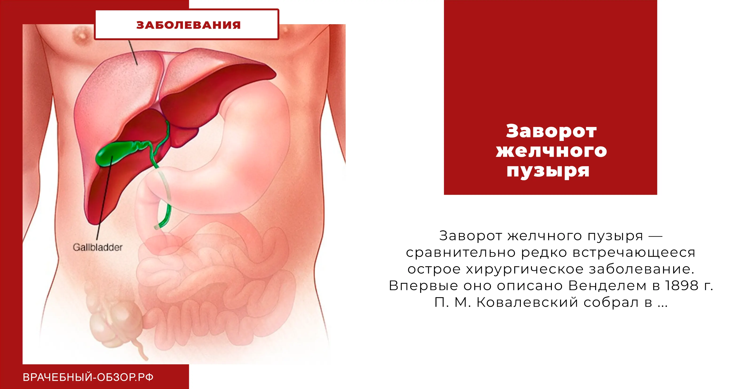 Заворот желчного пузыря
