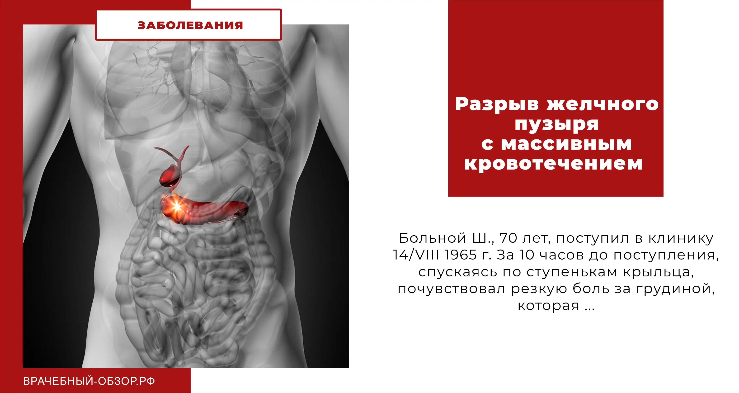 Разрыв желчного пузыря с массивным кровотечением