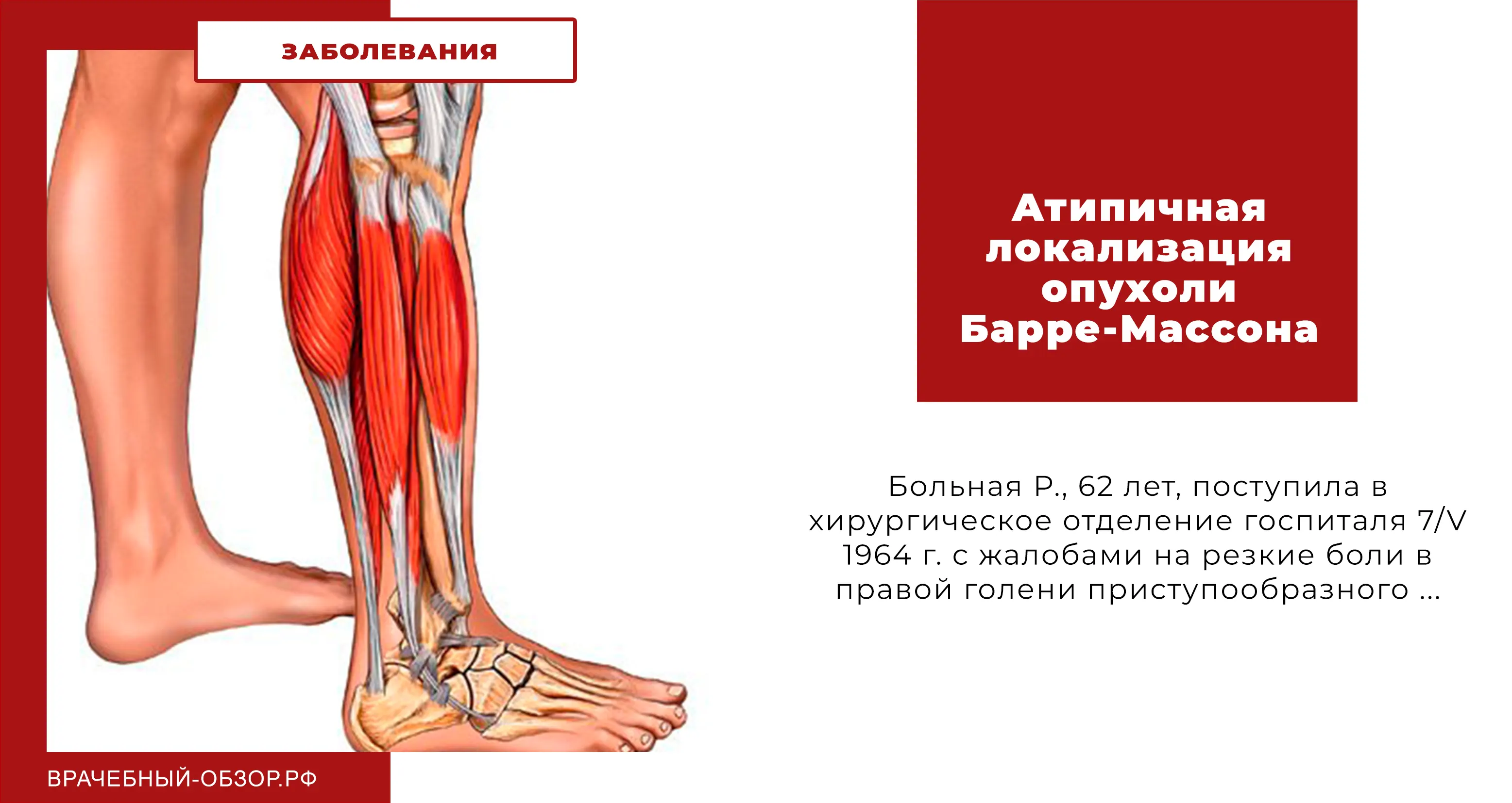 Атипичная локализация опухоли Барре-Массона