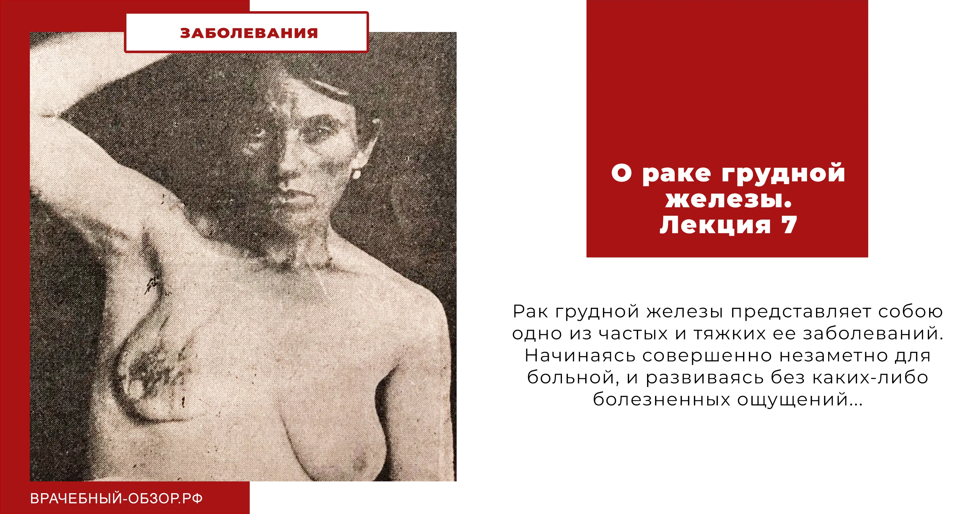 О раке грудной железы. Лекция 7