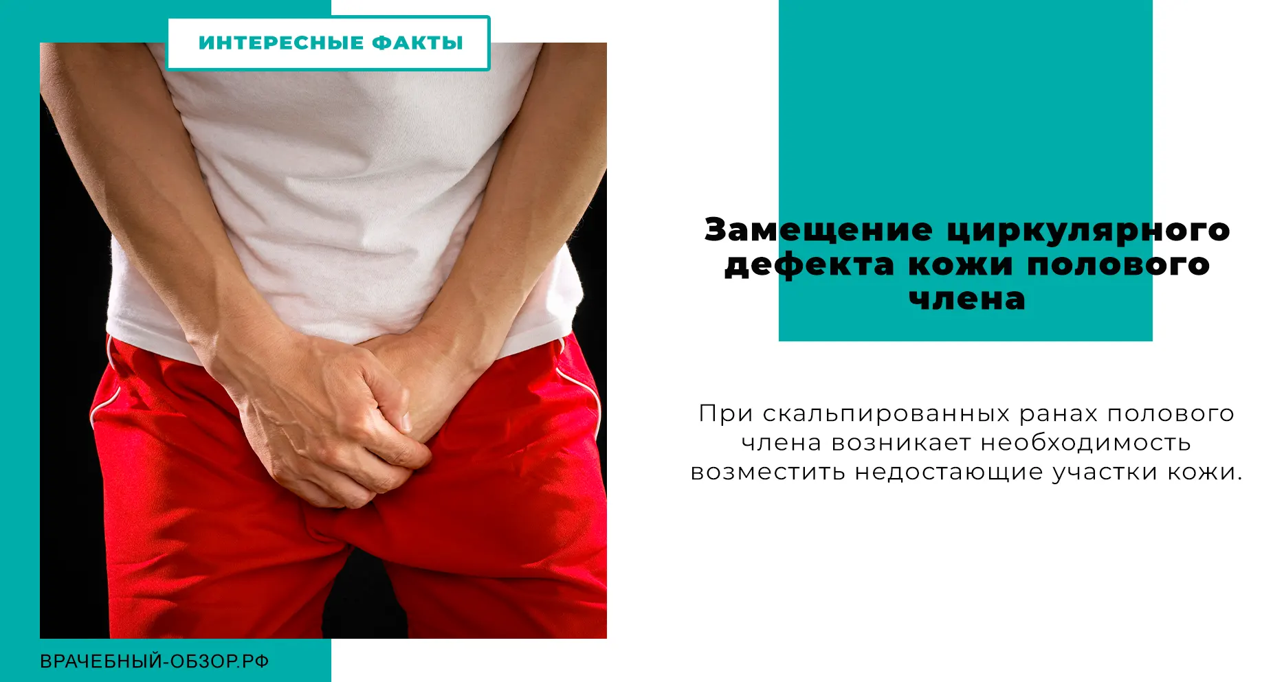 Замещение циркулярного дефекта кожи полового члена