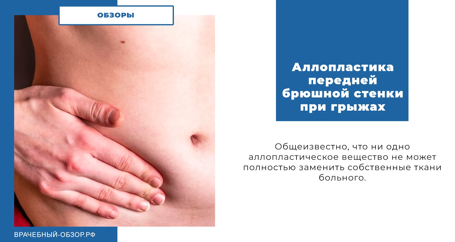 Аллопластика передней брюшной стенки при грыжах