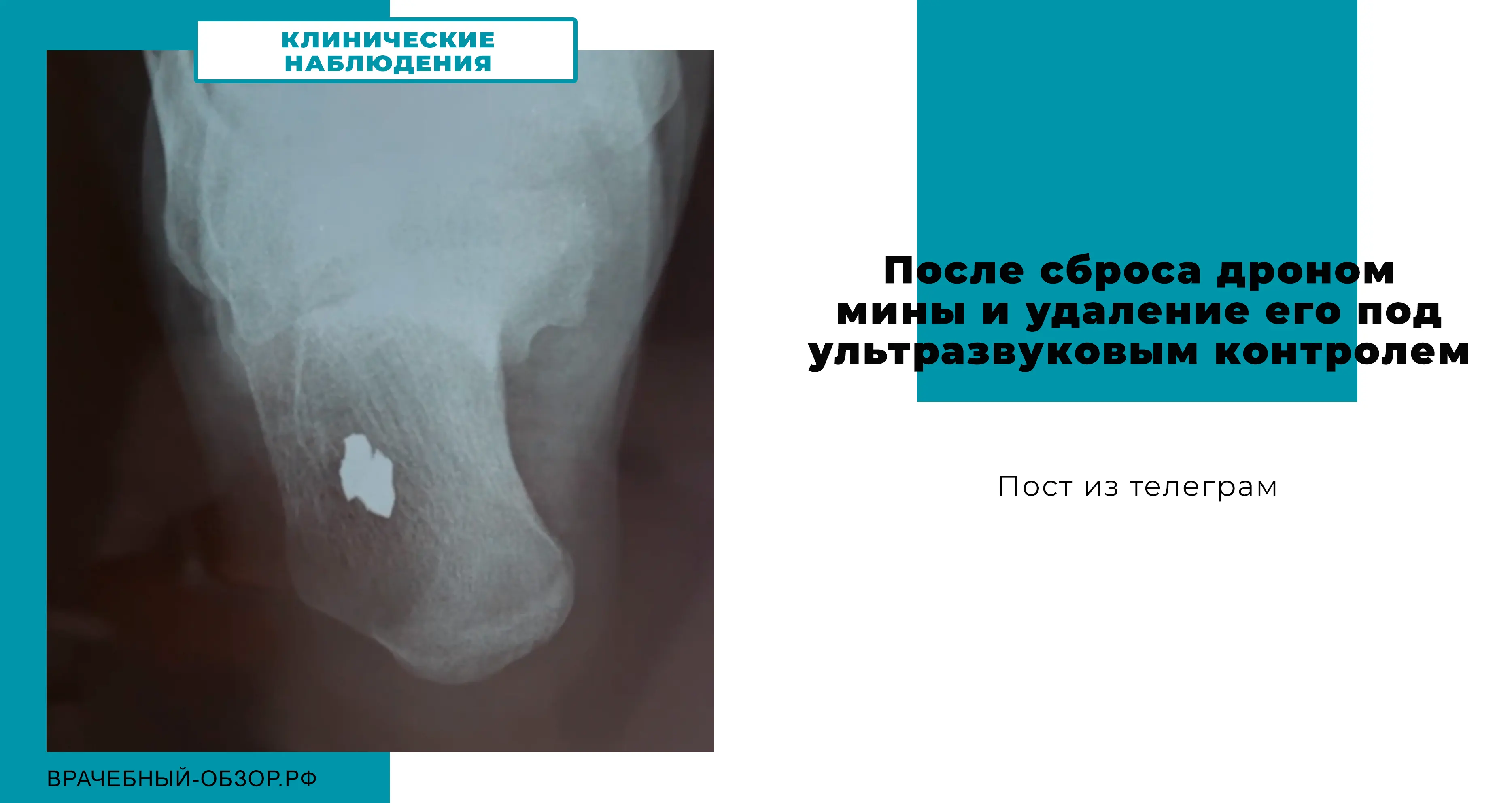После сброса дроном мины и удаление его под ультразвуковым контролем