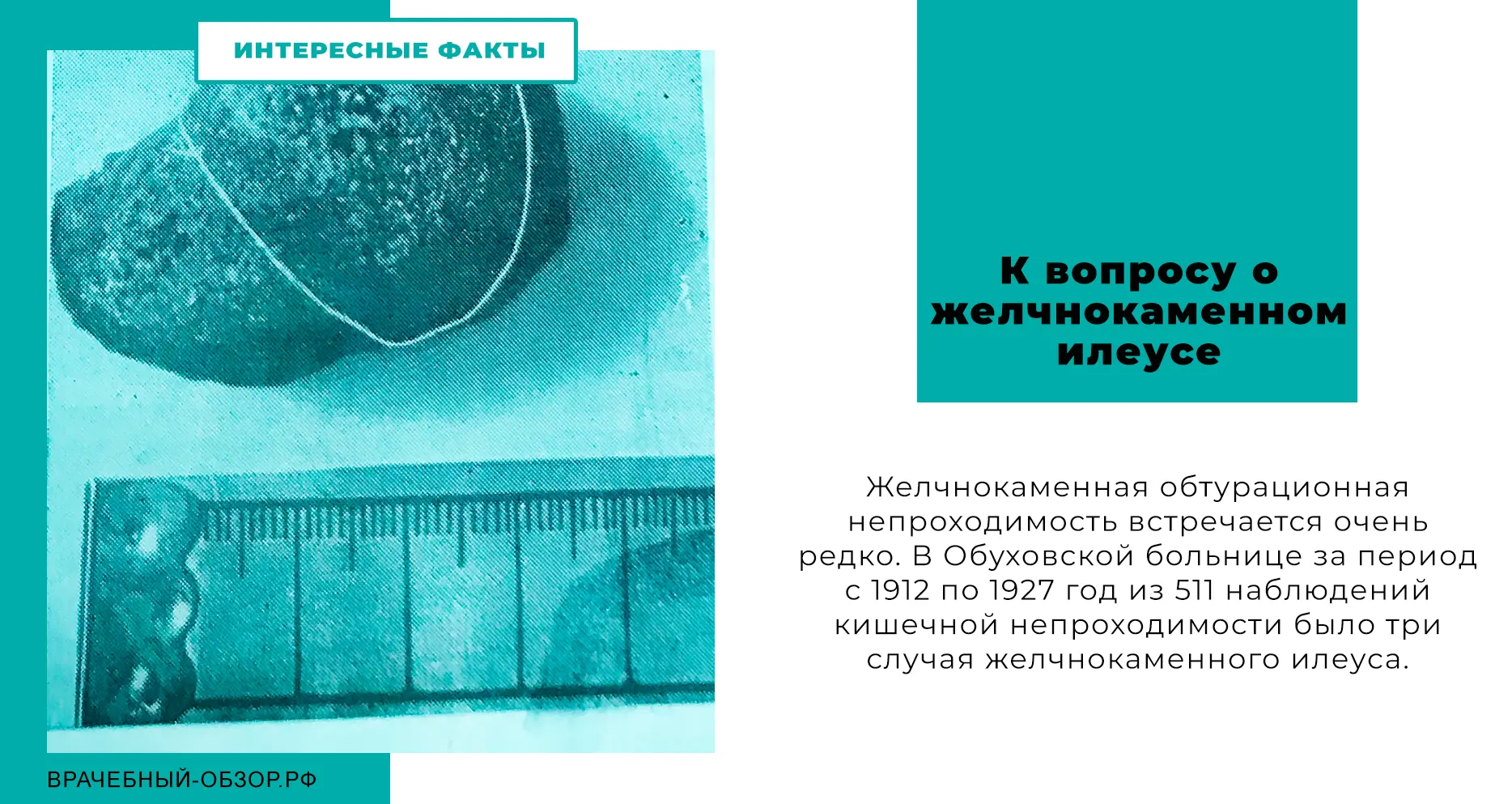 К вопросу о желчнокаменном илеусе