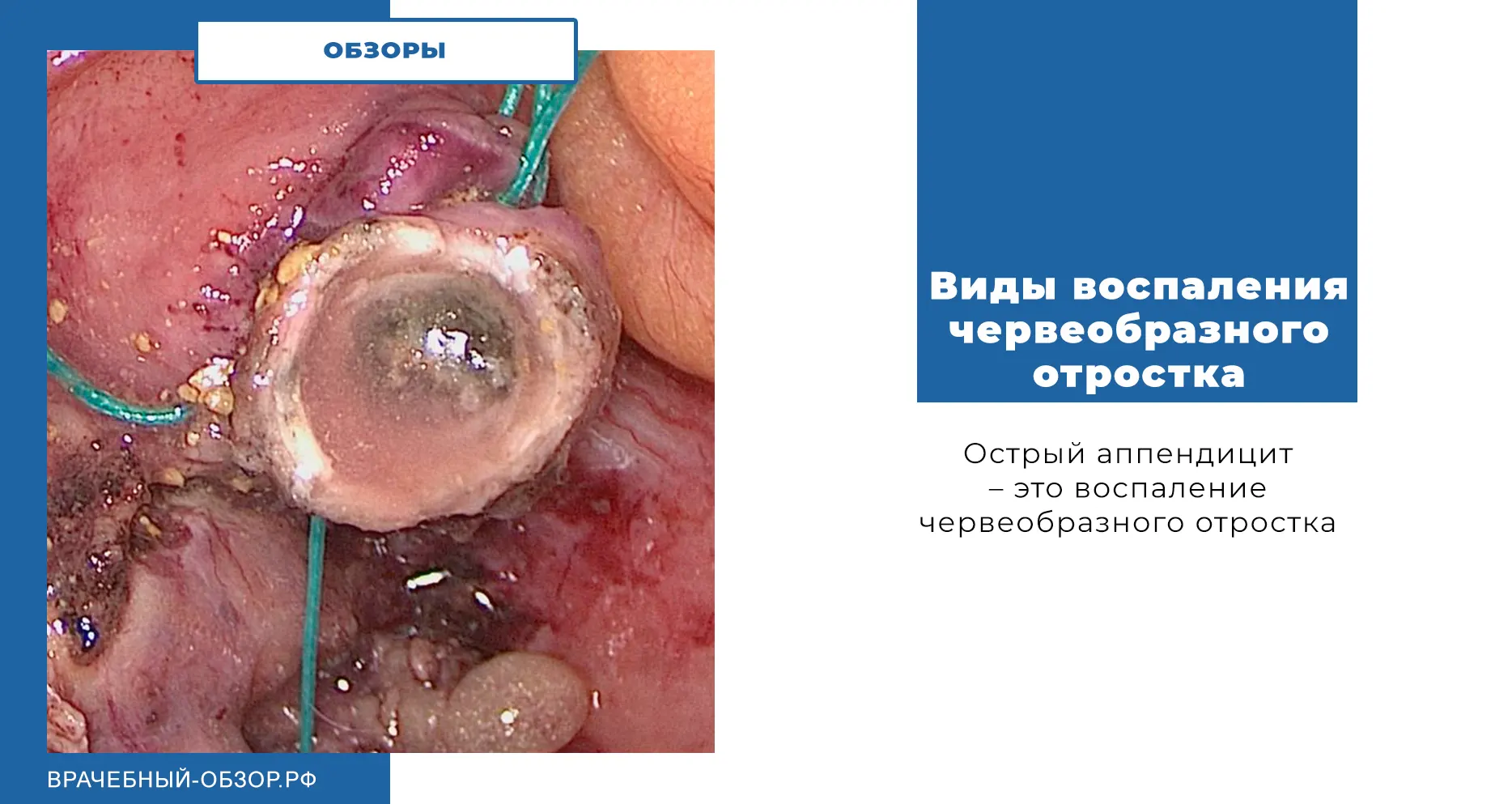 Виды воспаления червеобразного отростка