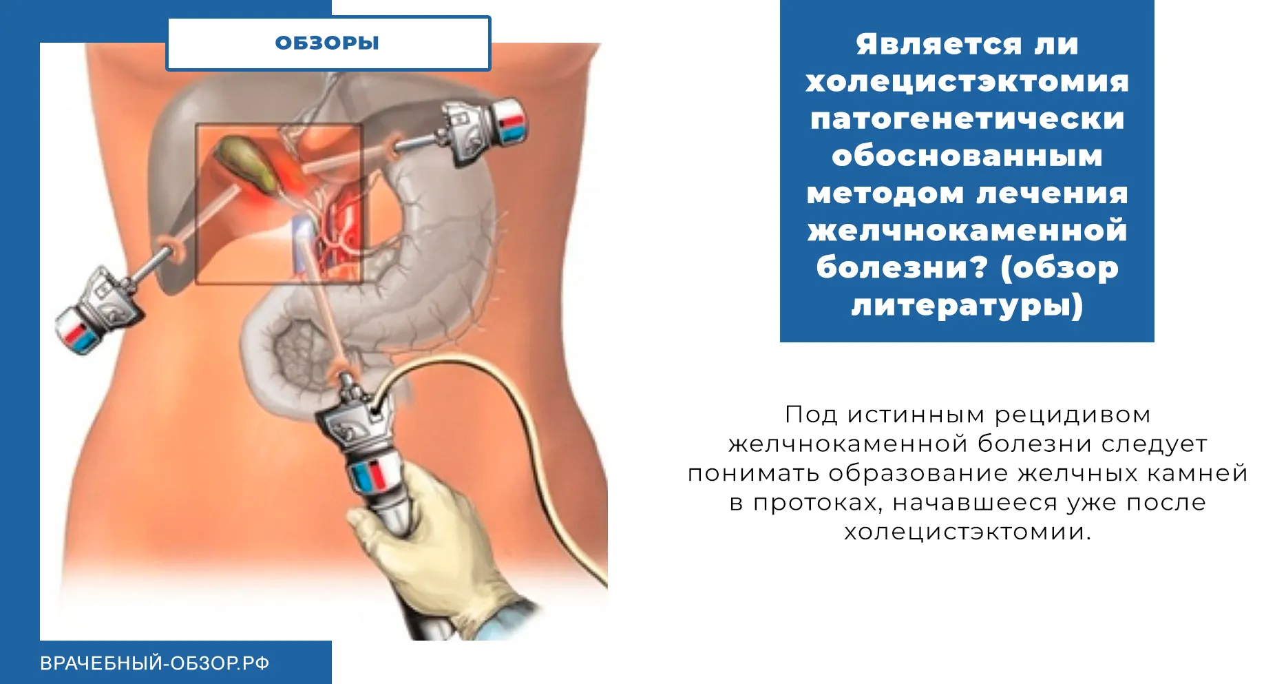 Является ли холецистэктомия патогенетически обоснованным методом лечения желчнокаменной болезни? (обзор литературы)
