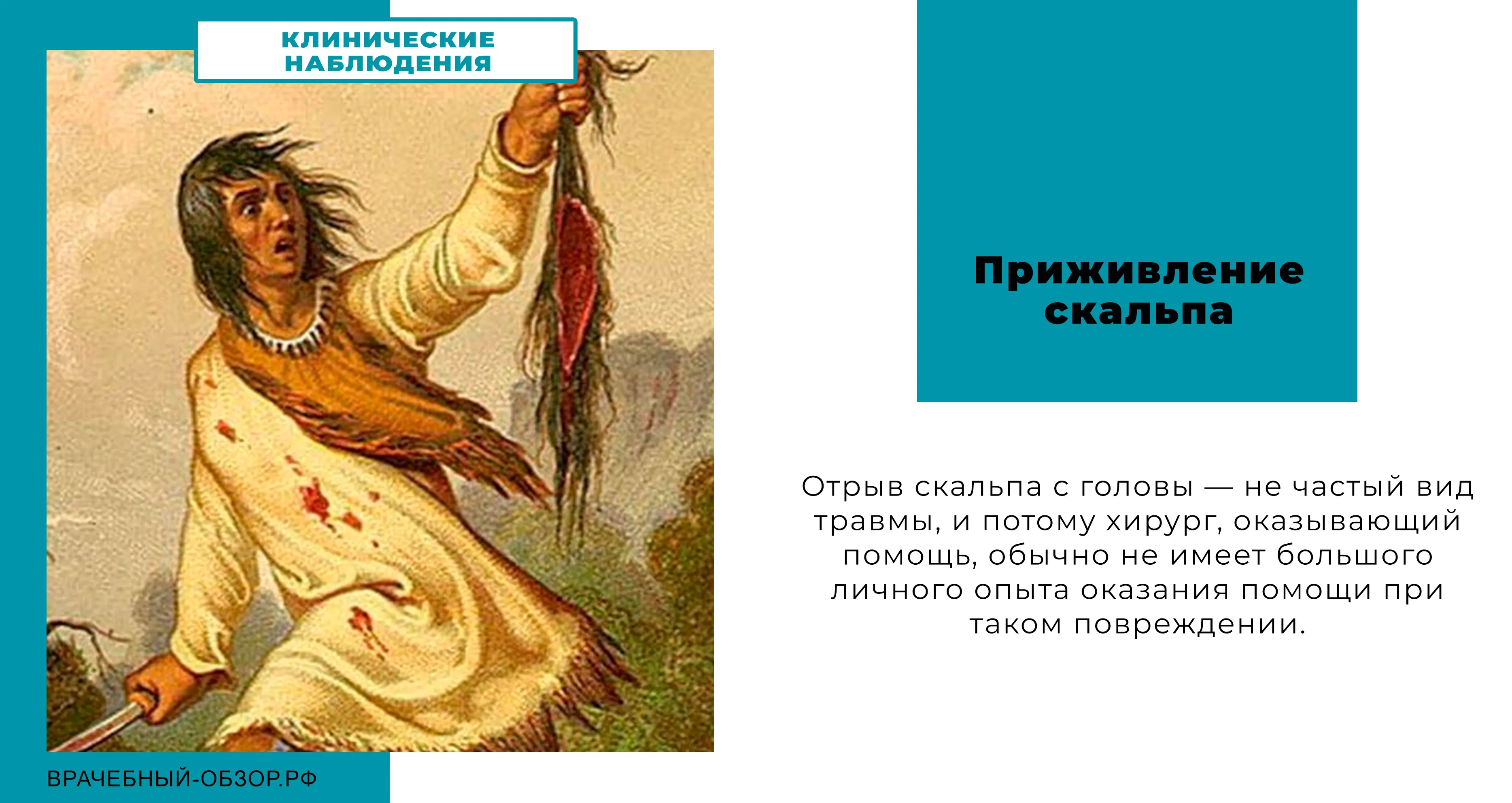 Приживление скальпа