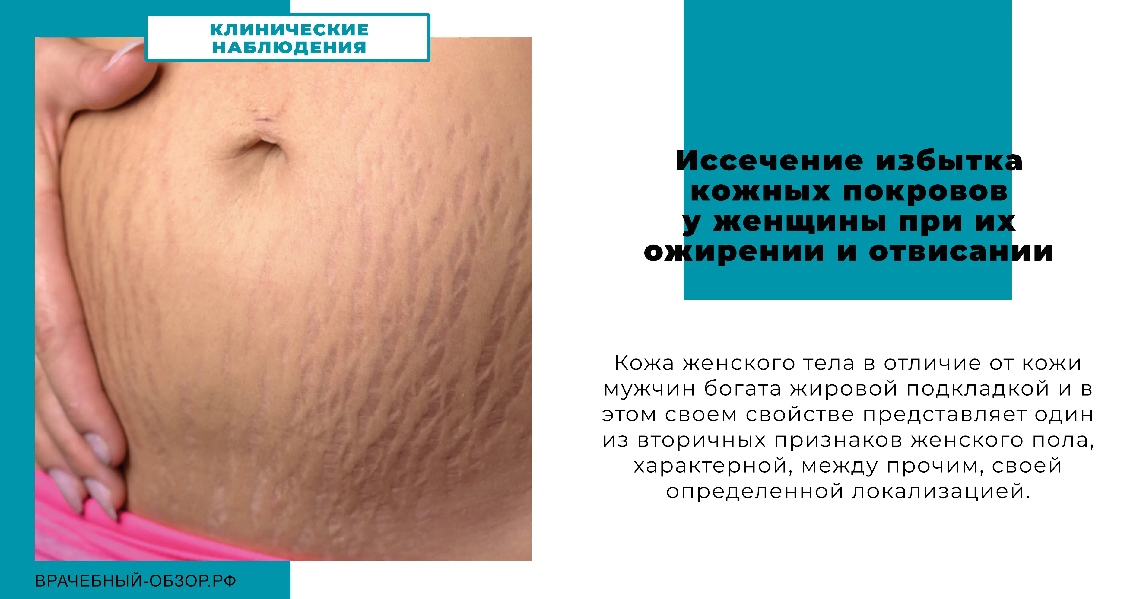 Иссечение избытка кожных покровов у женщины при их ожирении и отвисании