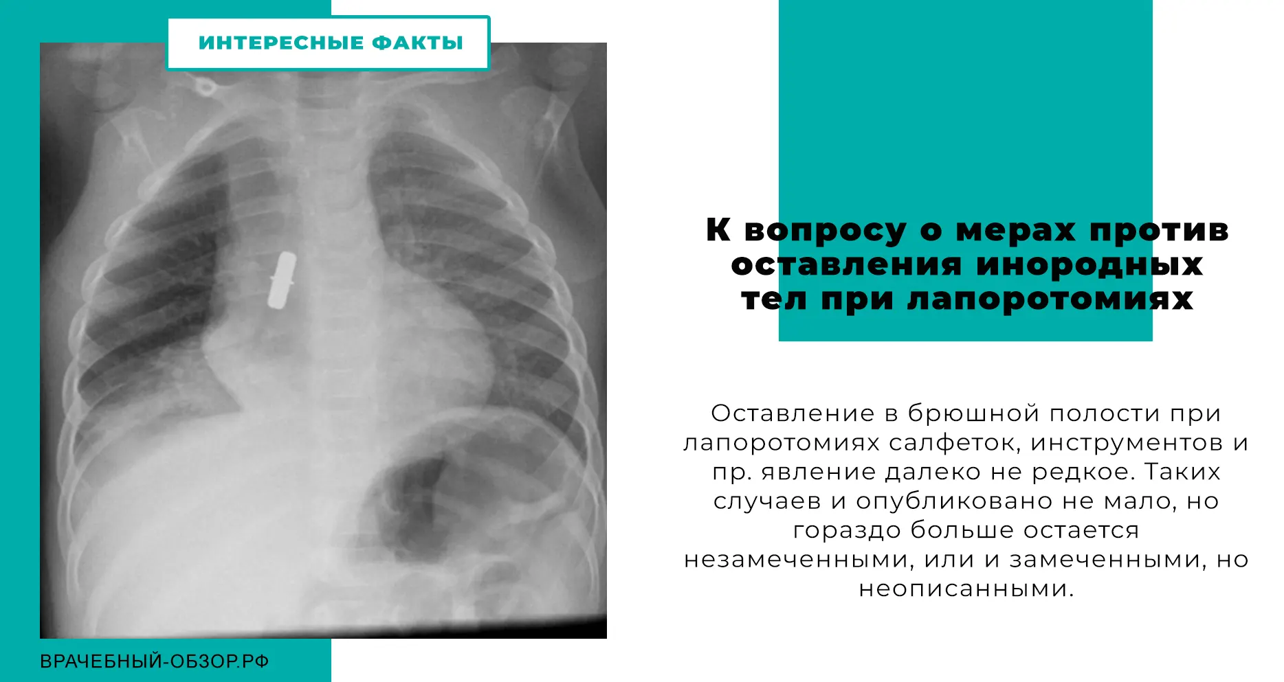 К вопросу о мерах против оставления инородных тел при лапоротомиях