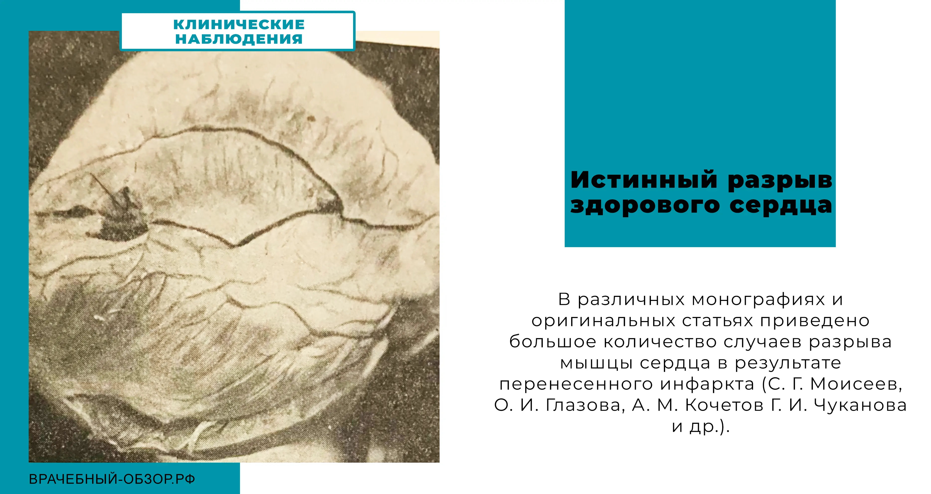 Истинный разрыв здорового сердца